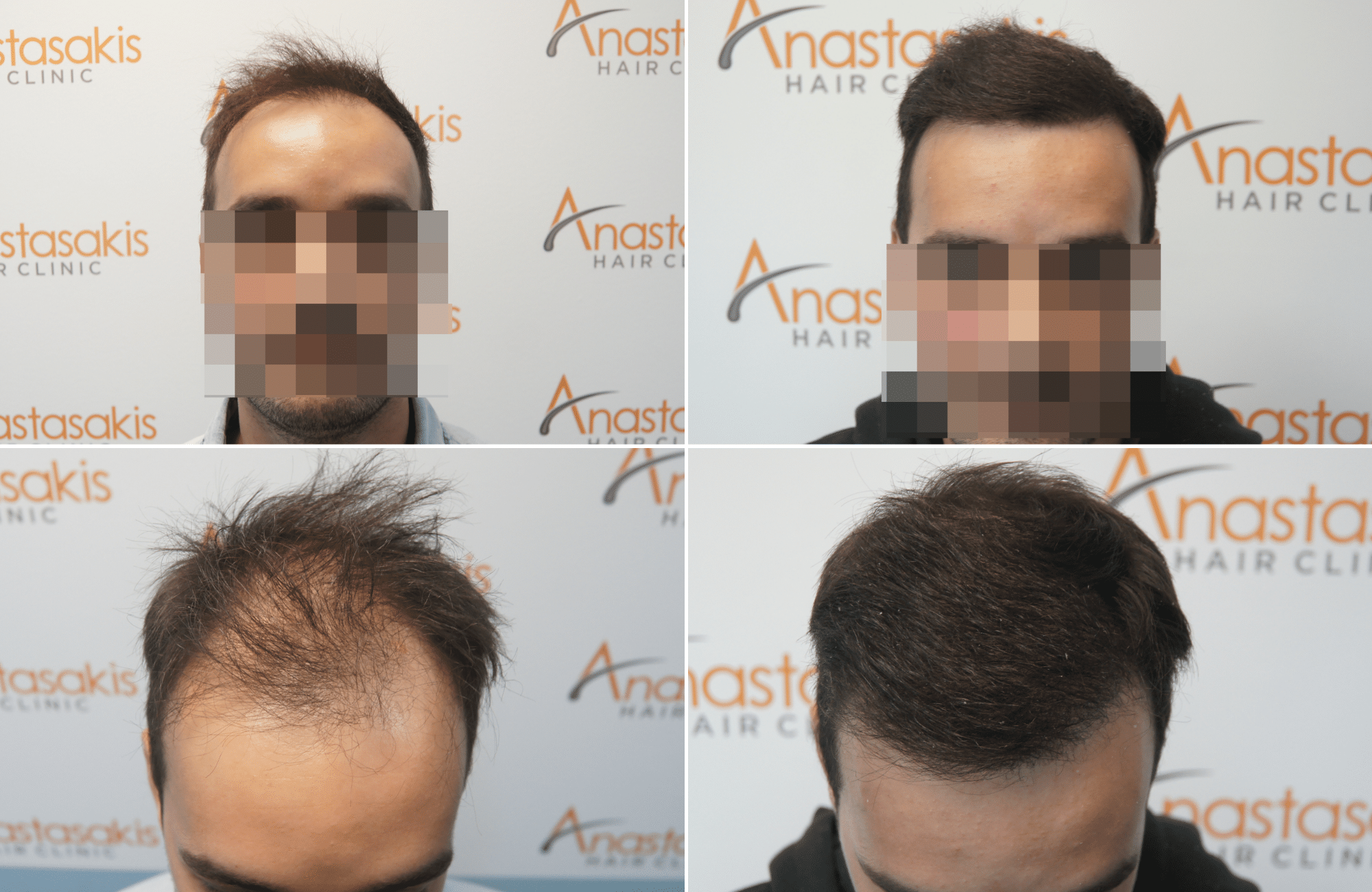 https://www.anastasakishairclinic.gr/portfolio/apotelesma-metamosxefsis-mallion-anastasakis-hair-clinic-376/