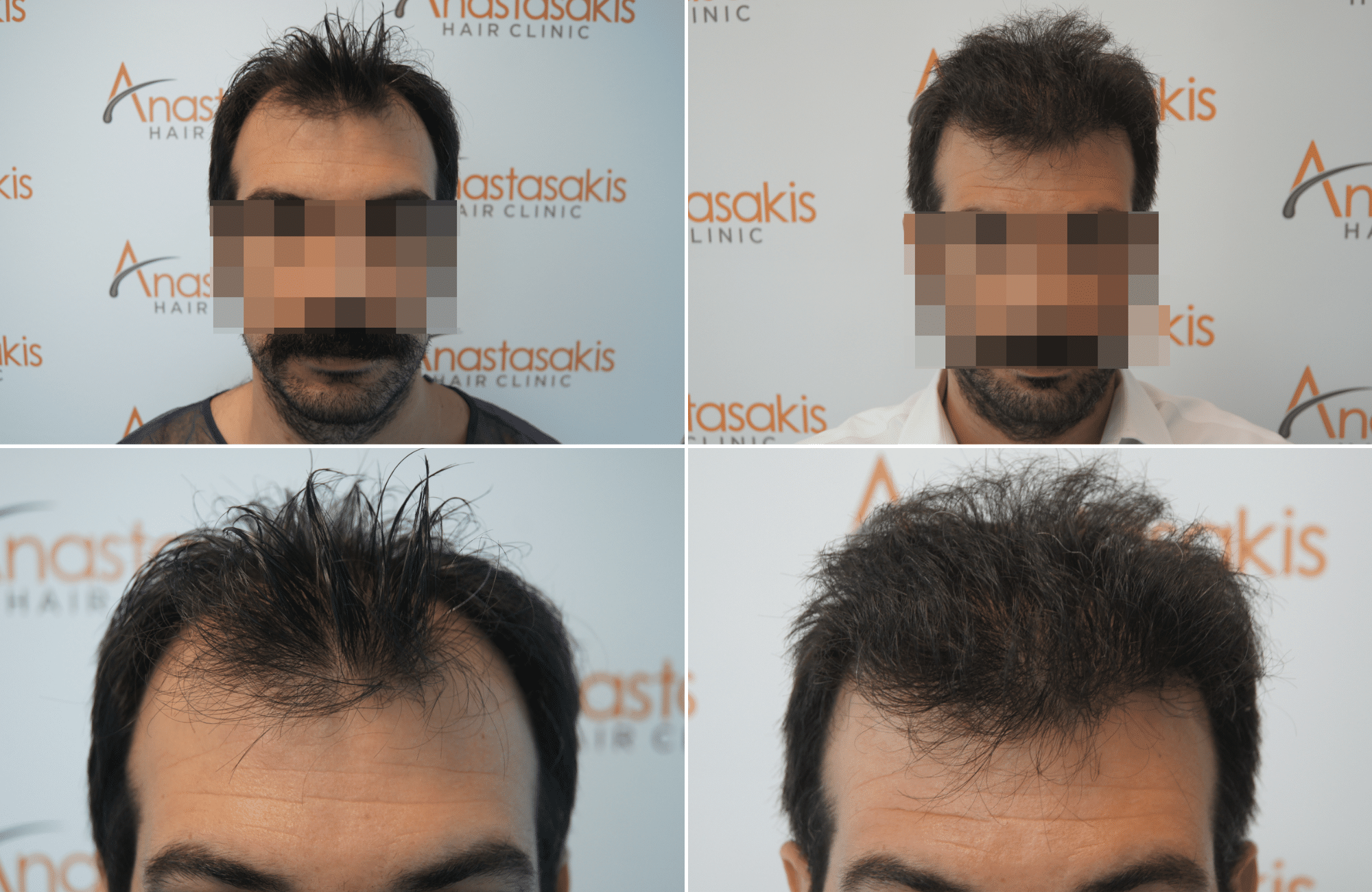 https://www.anastasakishairclinic.gr/portfolio/apotelesma-metamosxefsis-mallion-anastasakis-hair-clinic-377/