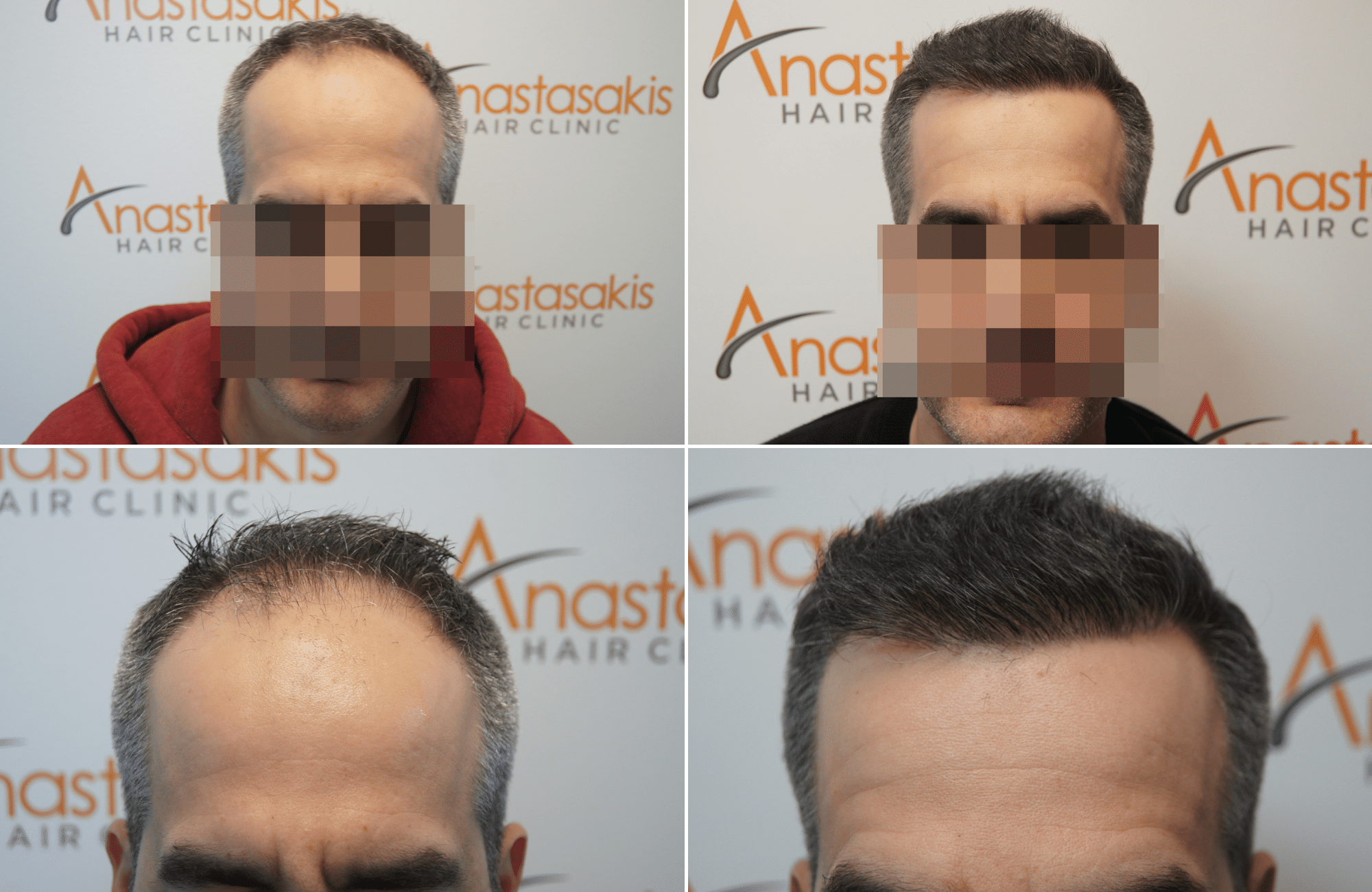 https://www.anastasakishairclinic.gr/portfolio/apotelesma-metamosxefsis-mallion-anastasakis-hair-clinic-379/
