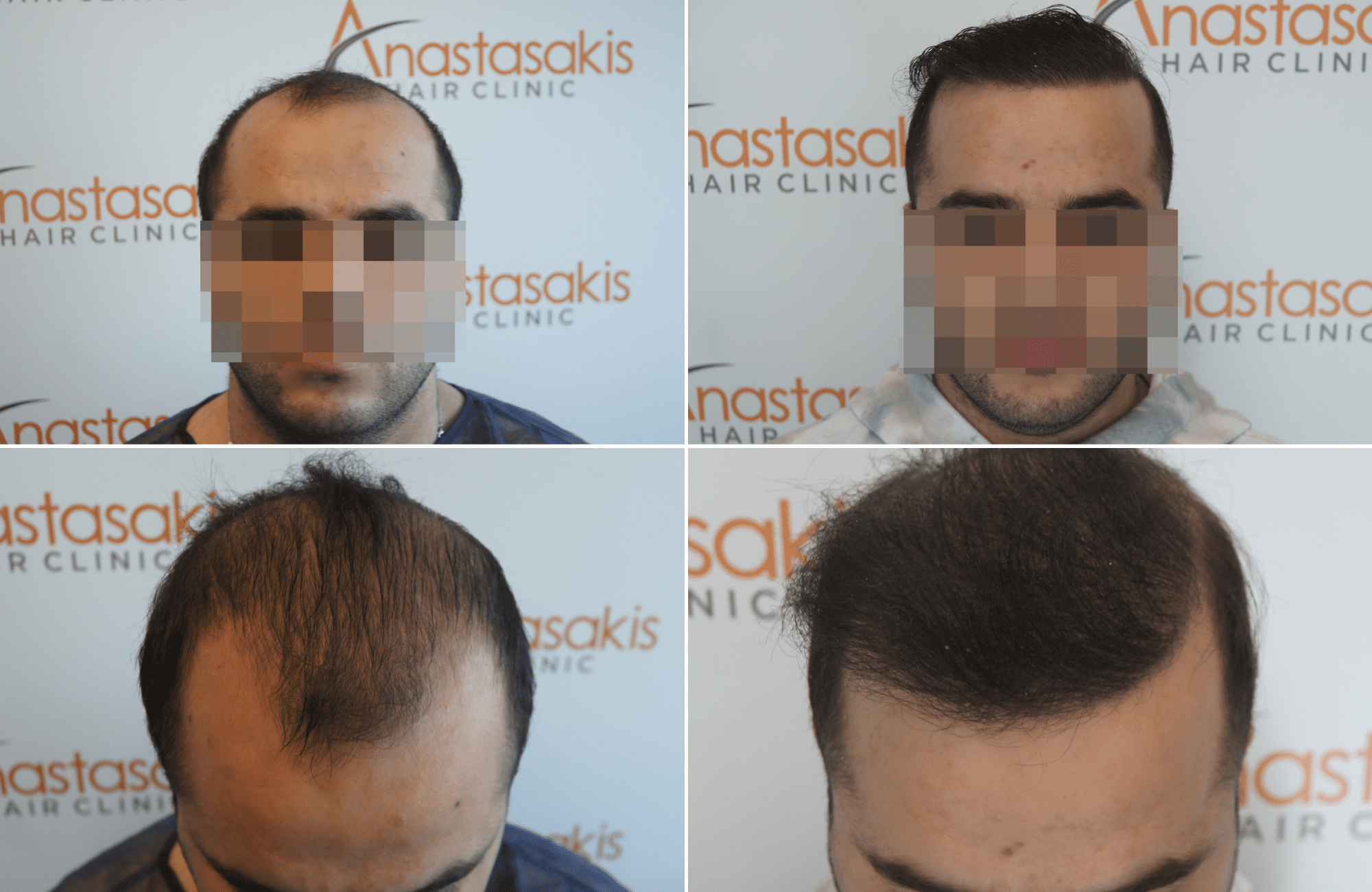 https://www.anastasakishairclinic.gr/portfolio/apotelesma-metamosxefsis-mallion-anastasakis-hair-clinic-381/