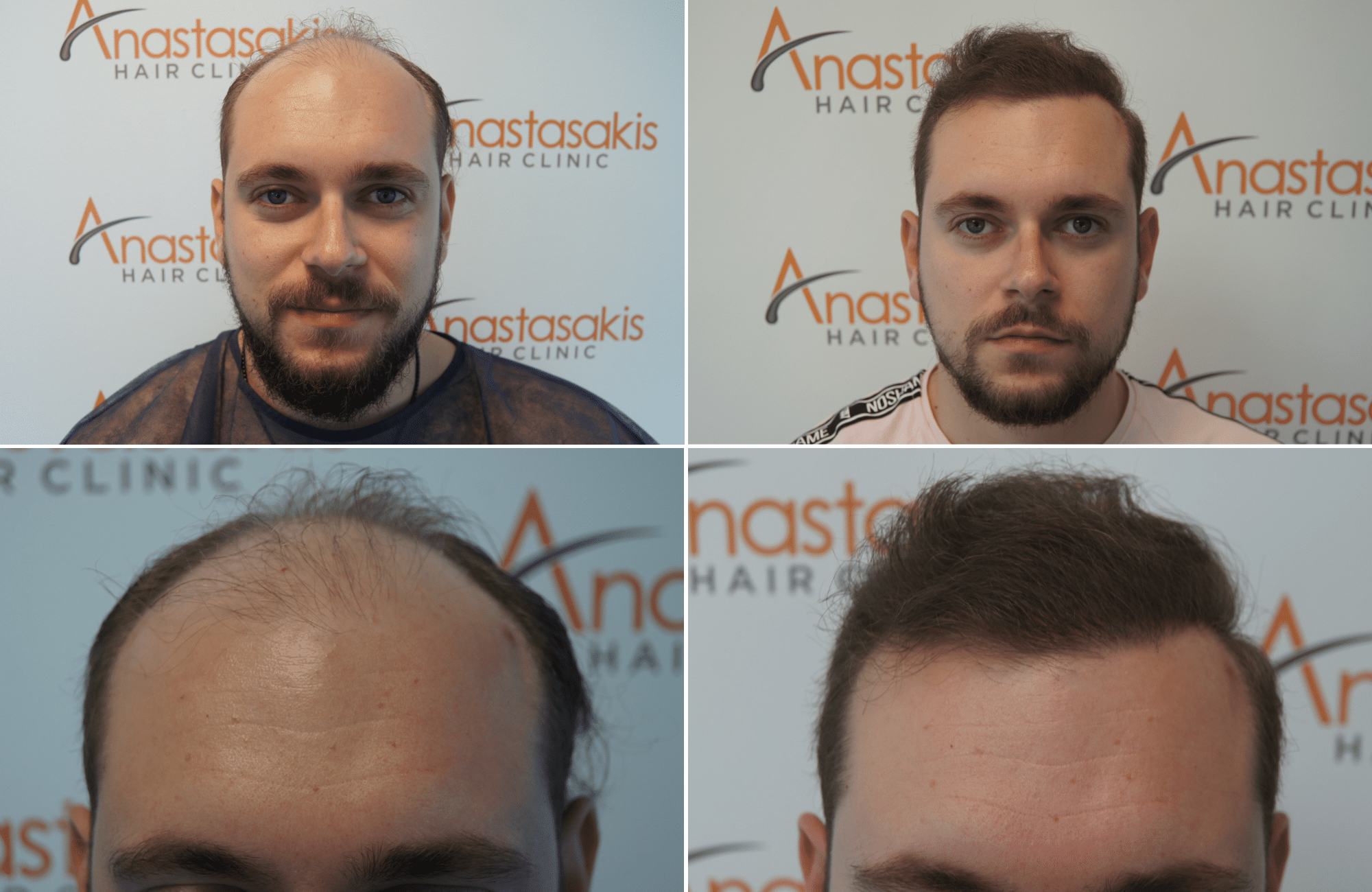 https://www.anastasakishairclinic.gr/portfolio/apotelesma-metamosxefsis-mallion-anastasakis-hair-clinic-245/