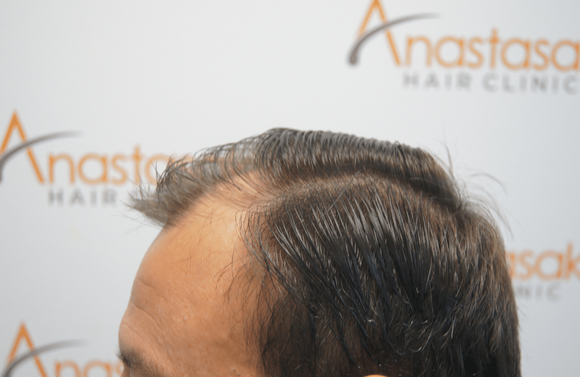 hair transplant patient result with 2500 fus before - side4