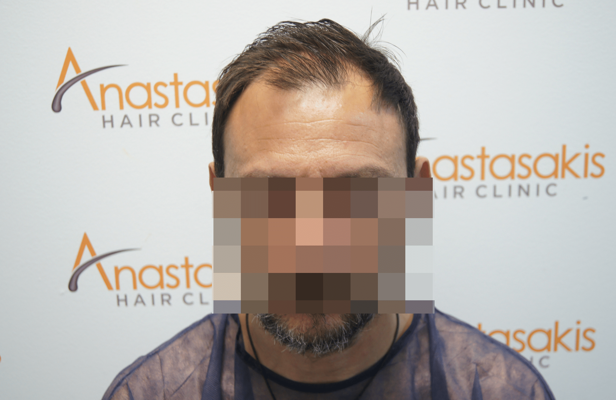 hair transplant patient result with 2500 fus before - fullface