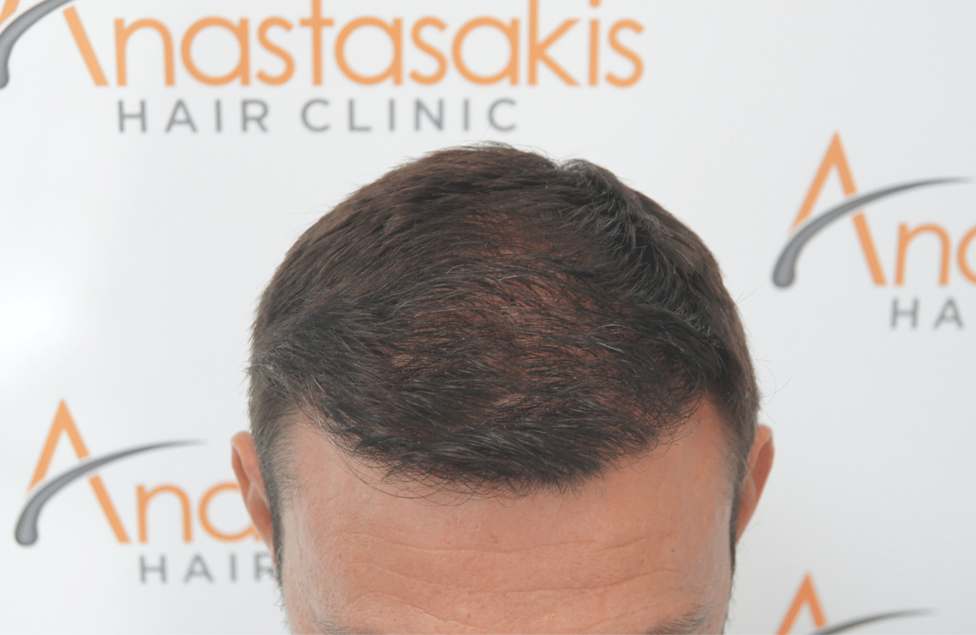 hair transplant patient result with 2500 fus after - up