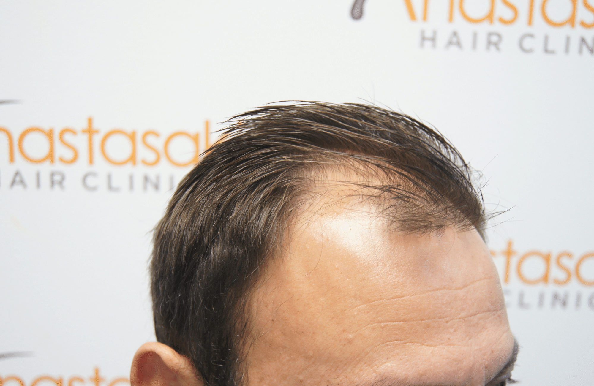 hair transplant patient result with 2500 fus before - side2