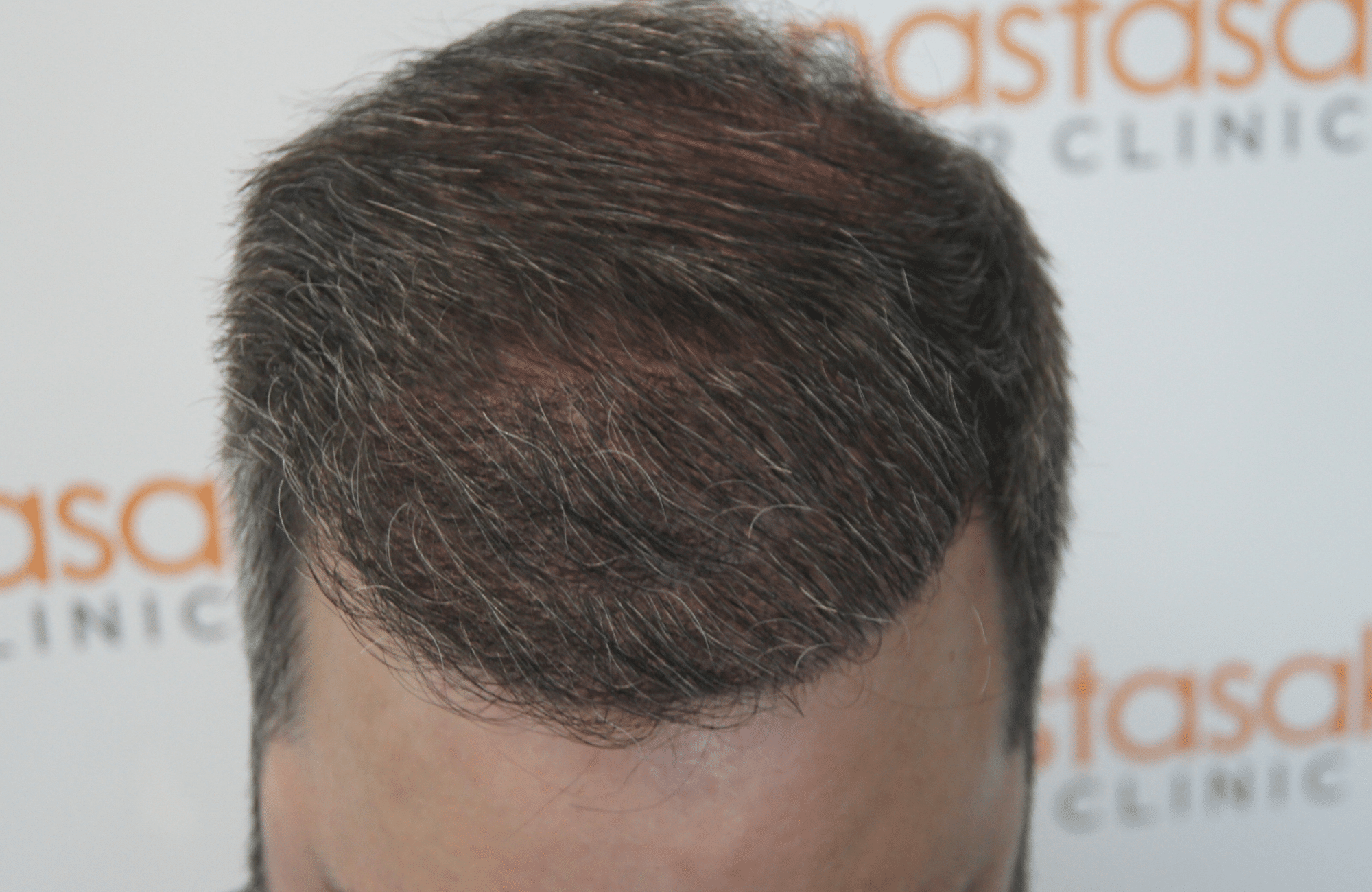 hair transplant patient result with 3500 fus after - up