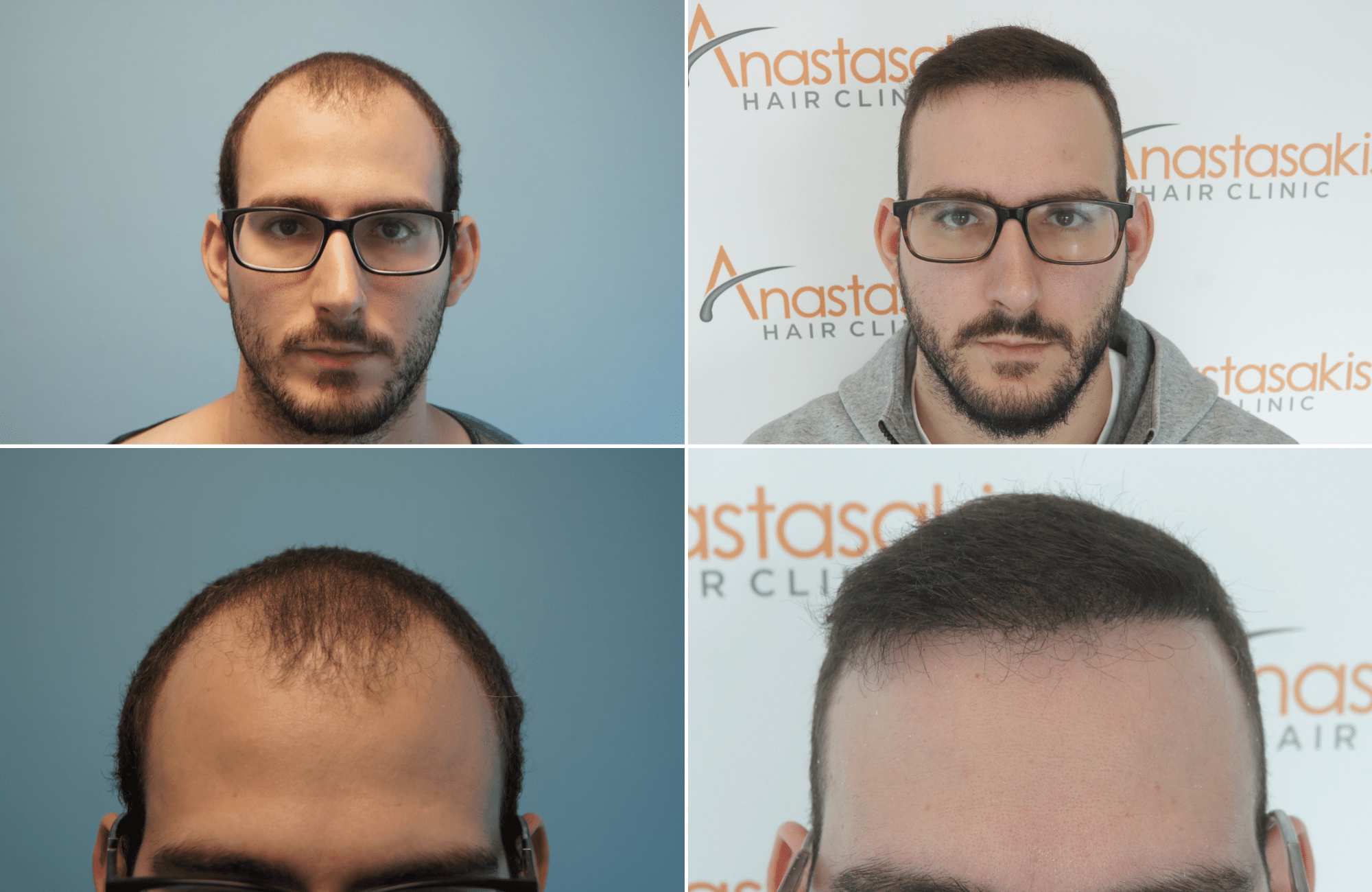 https://www.anastasakishairclinic.gr/portfolio/apotelesma-metamosxefsis-mallion-anastasakis-hair-clinic-380/