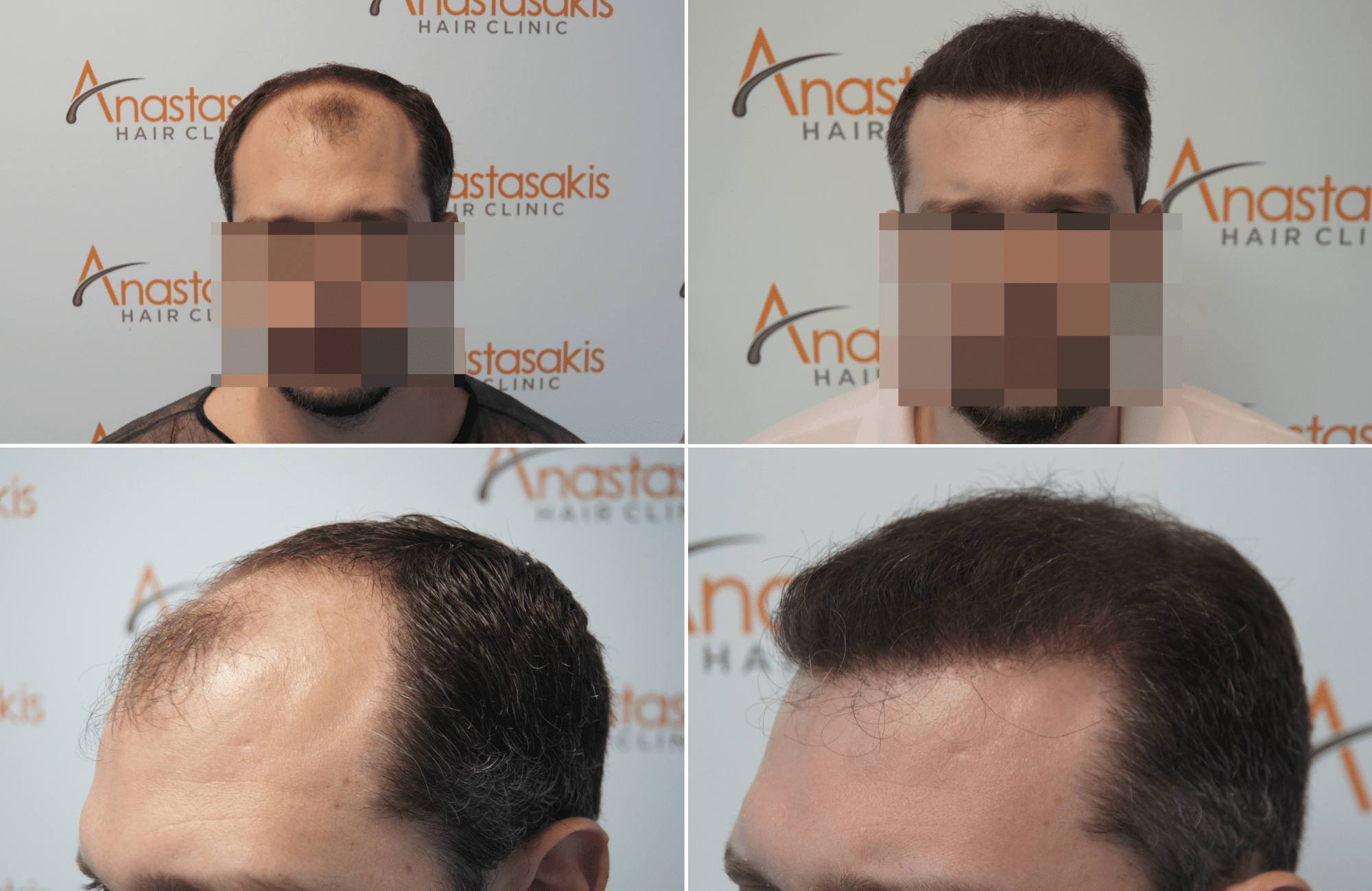 https://www.anastasakishairclinic.gr/portfolio/apotelesma-metamosxefsis-mallion-anastasakis-hair-clinic-79/