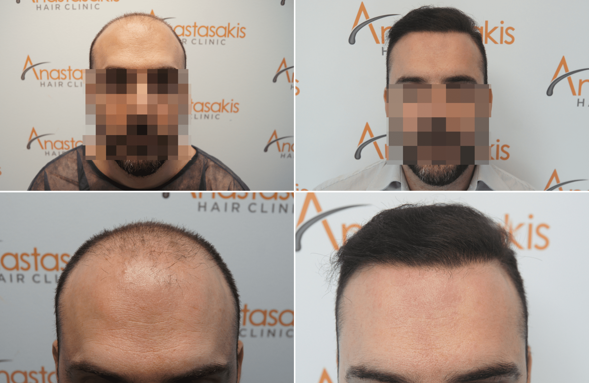 https://www.anastasakishairclinic.gr/portfolio/apotelesma-metamosxefsis-mallion-anastasakis-hair-clinic-225/