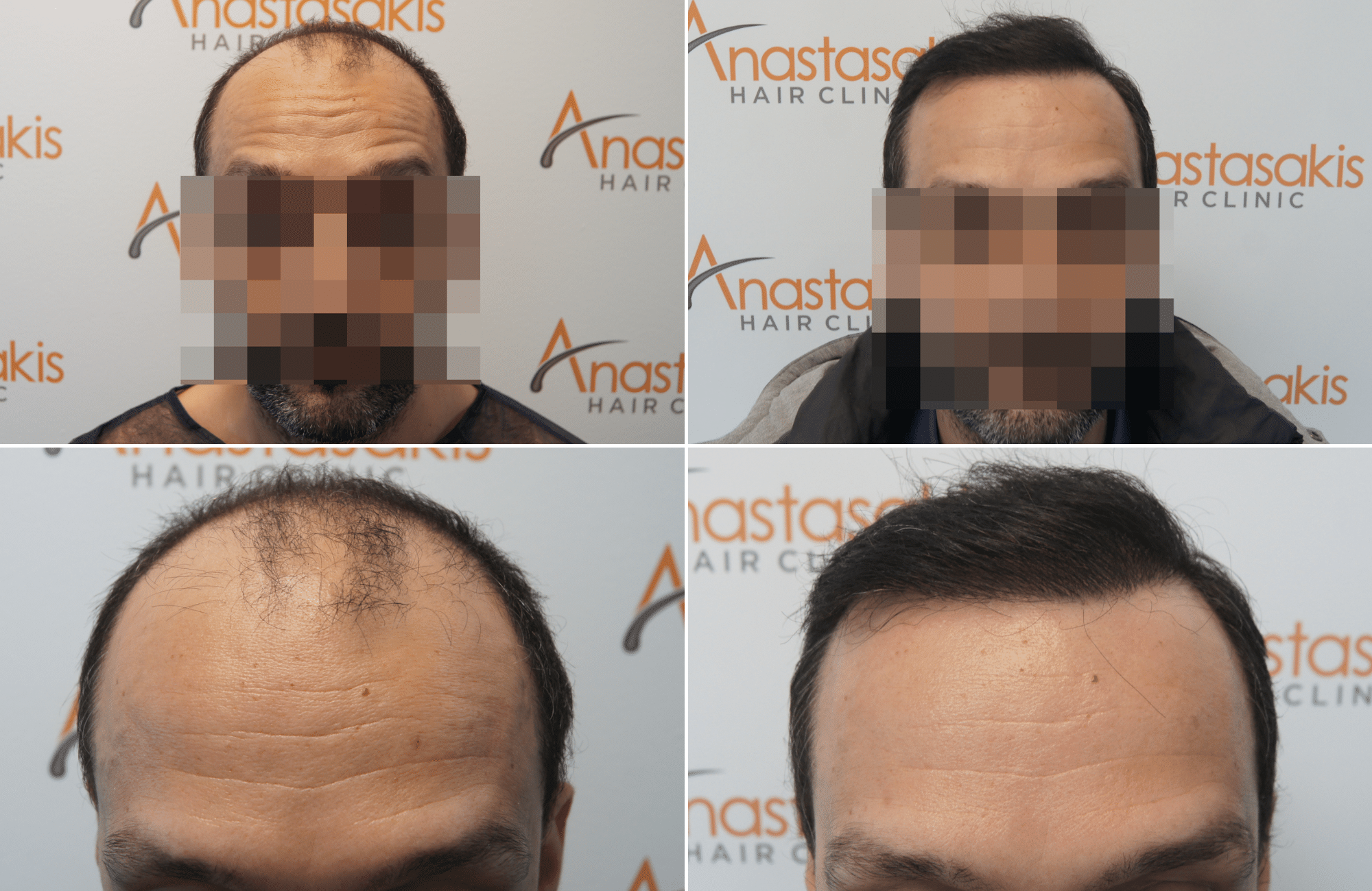 https://www.anastasakishairclinic.gr/portfolio/apotelesma-metamosxefsis-mallion-anastasakis-hair-clinic-378/