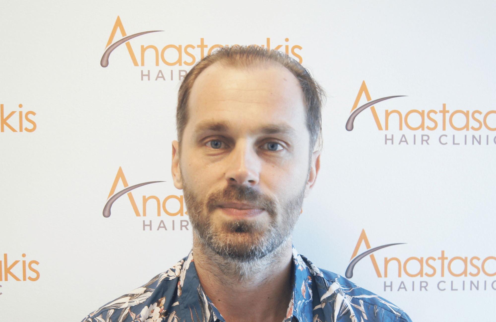 hair transplant result