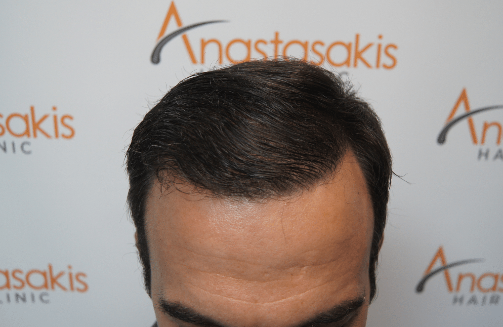 hair transplant patient result with 2500 fus after - frontal wet hair