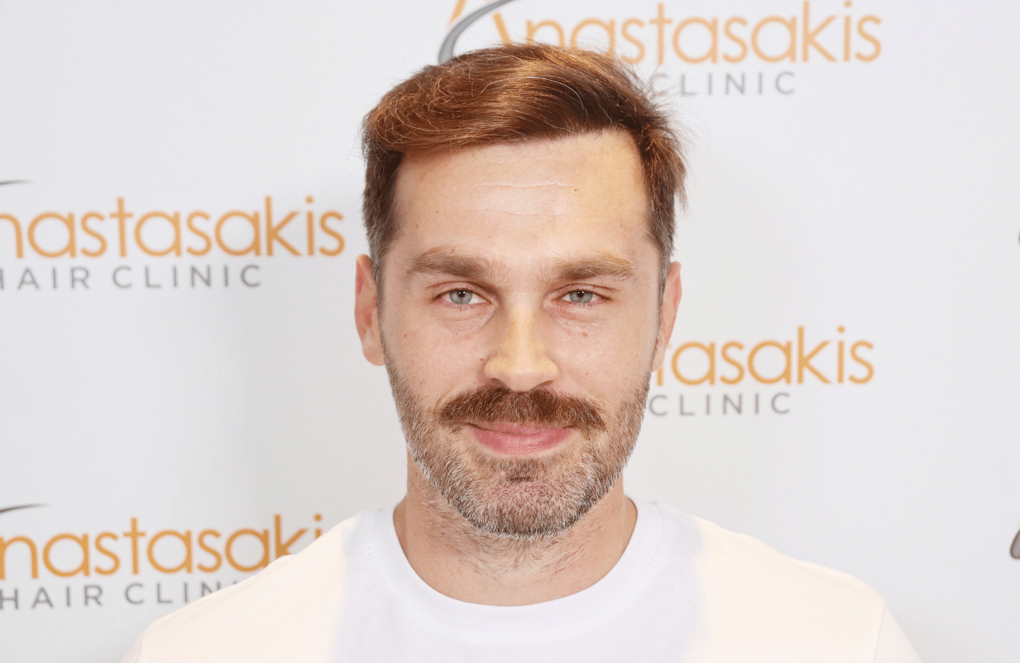 hair transplant result
