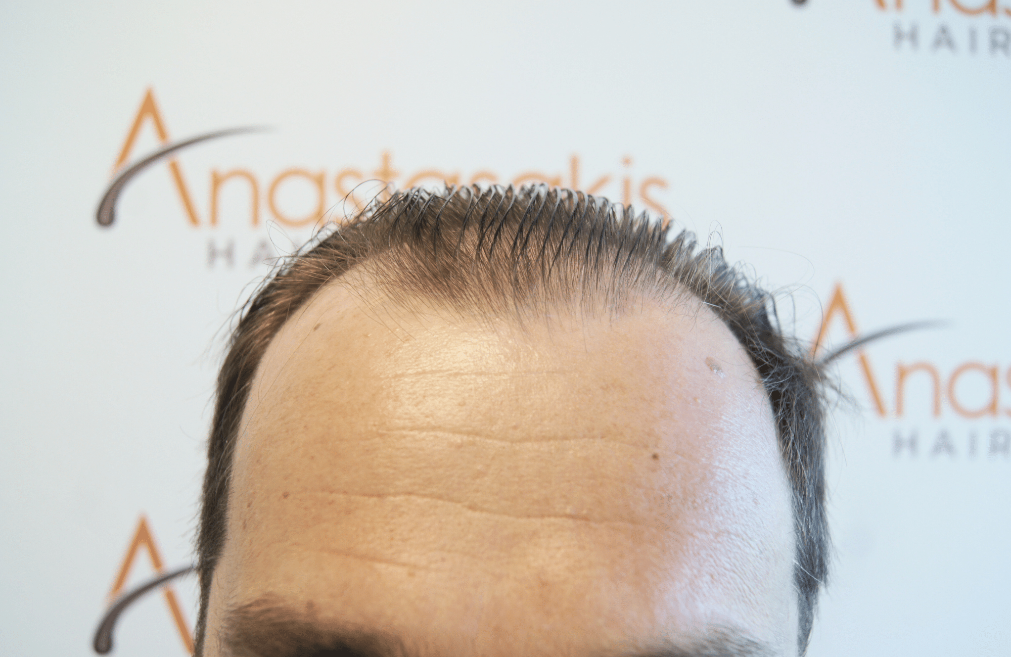hair transplant result