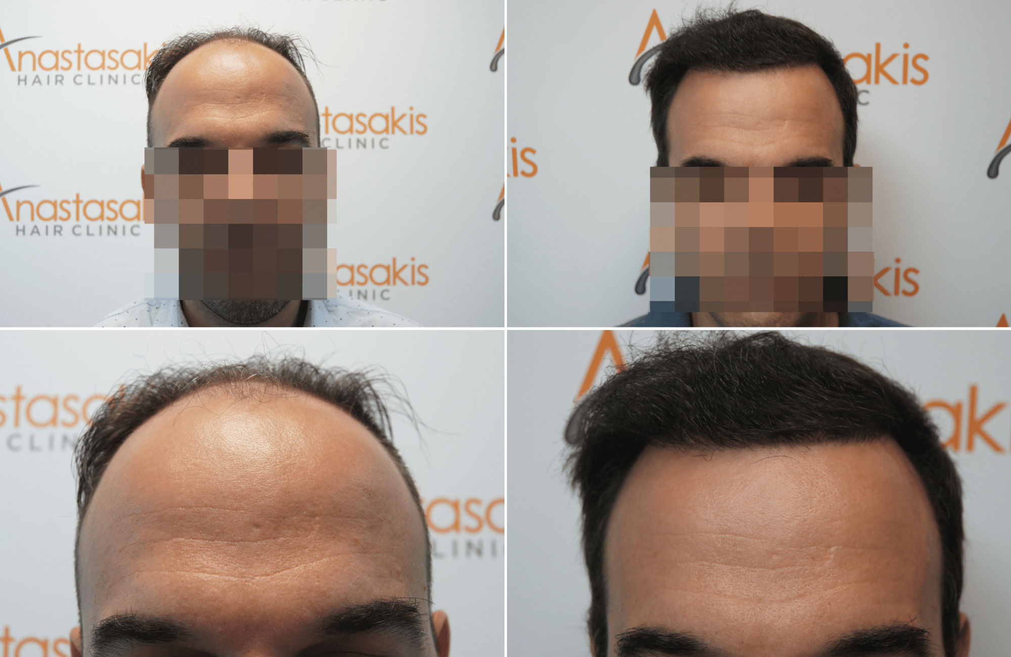https://www.anastasakishairclinic.gr/portfolio/apotelesma-metamosxefsis-mallion-anastasakis-hair-clinic-385/
