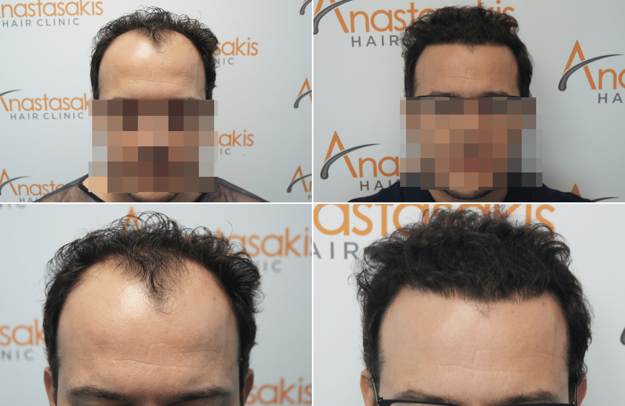 https://www.anastasakishairclinic.gr/portfolio/apotelesma-metamosxefsis-mallion-anastasakis-hair-clinic-386/