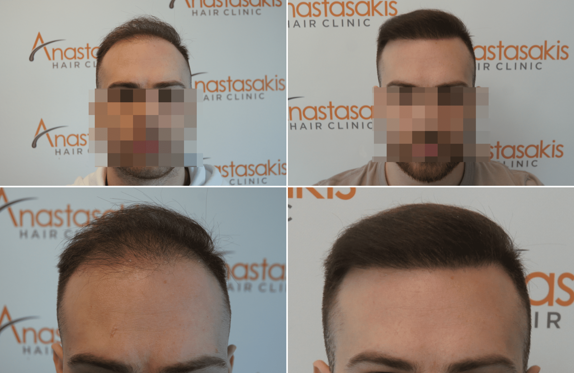 https://www.anastasakishairclinic.gr/portfolio/apotelesma-metamosxefsis-mallion-anastasakis-hair-clinic-388/