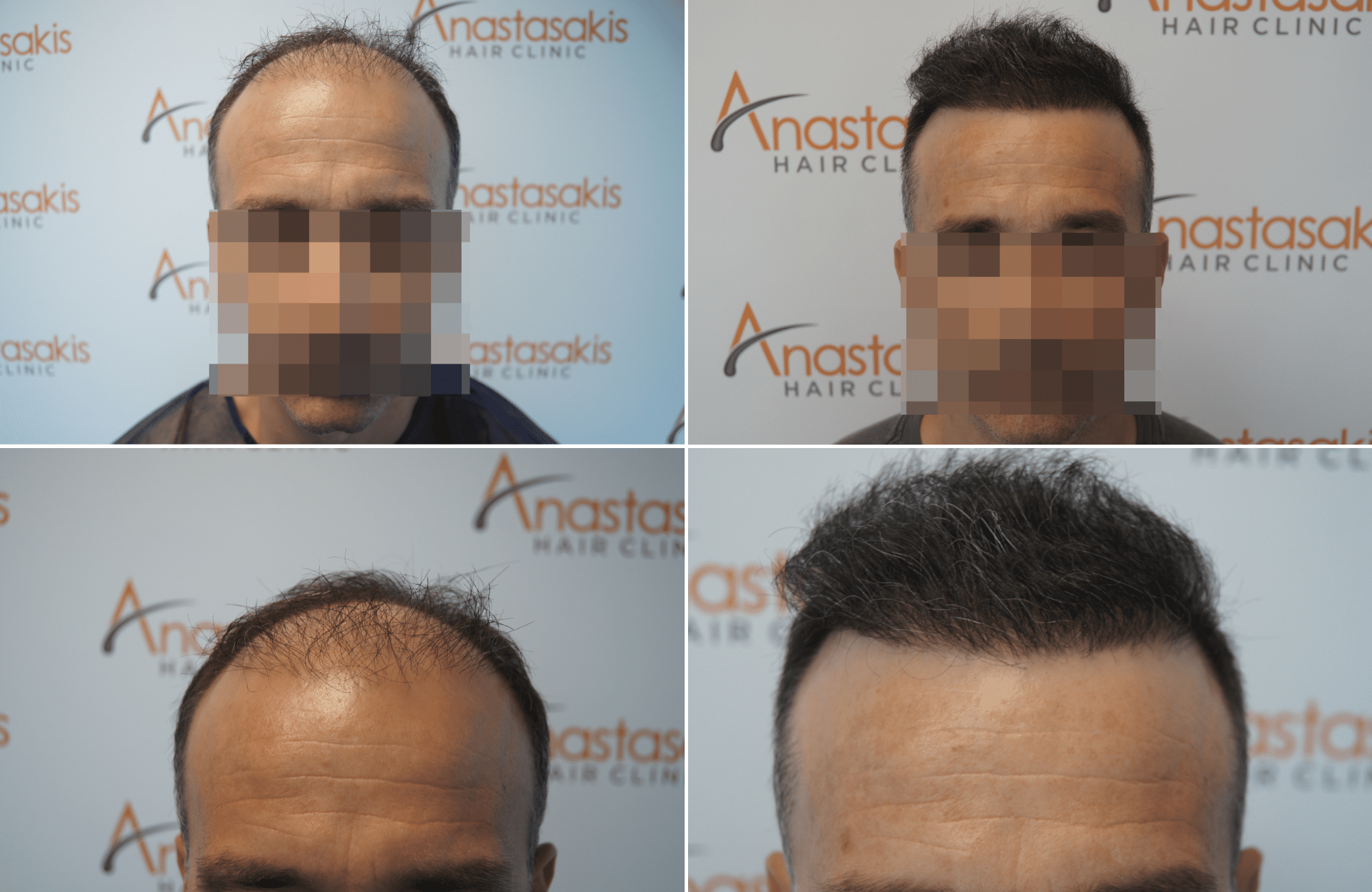 https://www.anastasakishairclinic.gr/portfolio/apotelesma-metamosxefsis-mallion-anastasakis-hair-clinic-389/