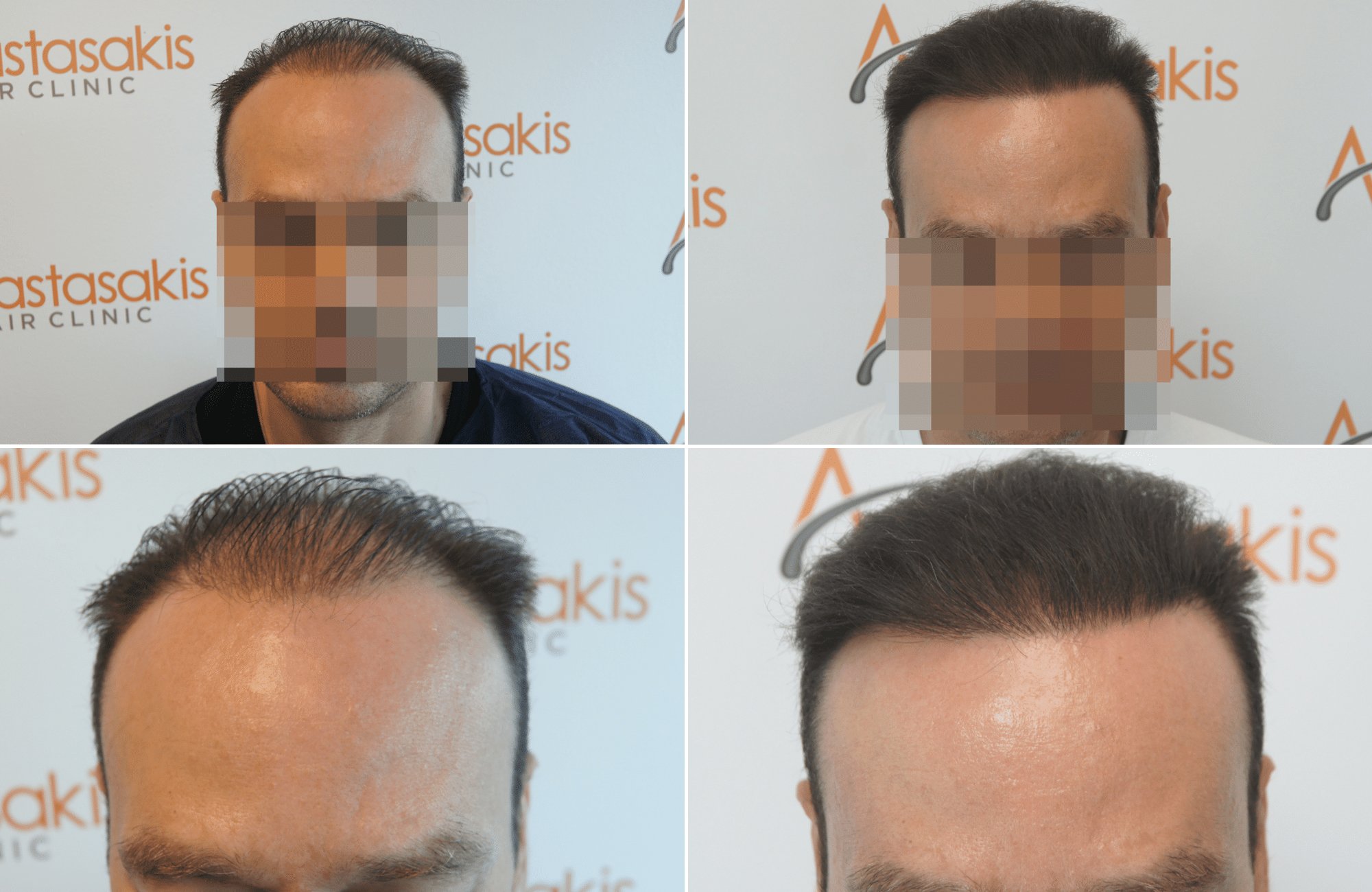 https://www.anastasakishairclinic.gr/portfolio/apotelesma-metamosxefsis-mallion-anastasakis-hair-clinic-390/