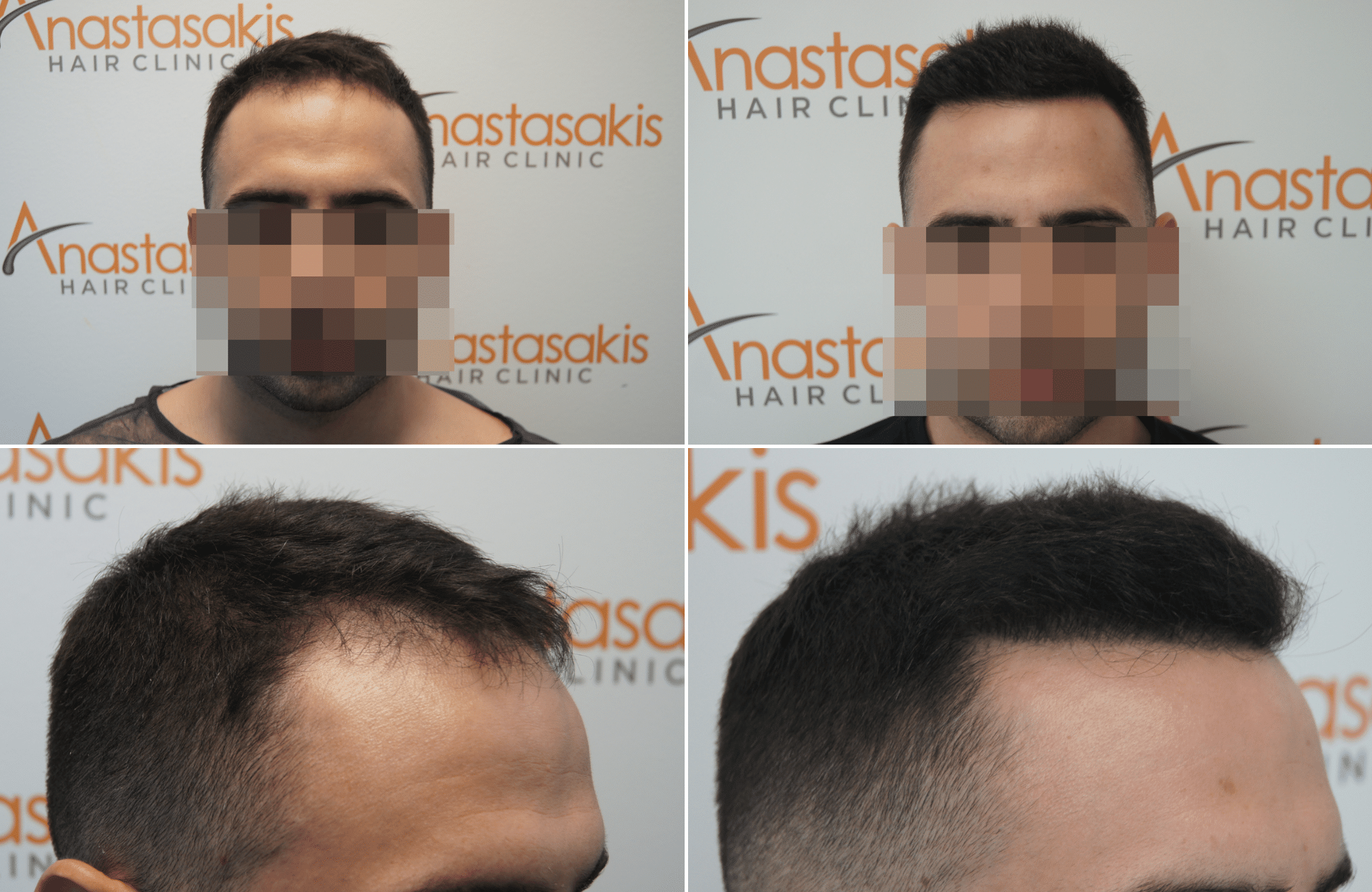 https://www.anastasakishairclinic.gr/portfolio/apotelesma-metamosxefsis-mallion-anastasakis-hair-clinic-391/