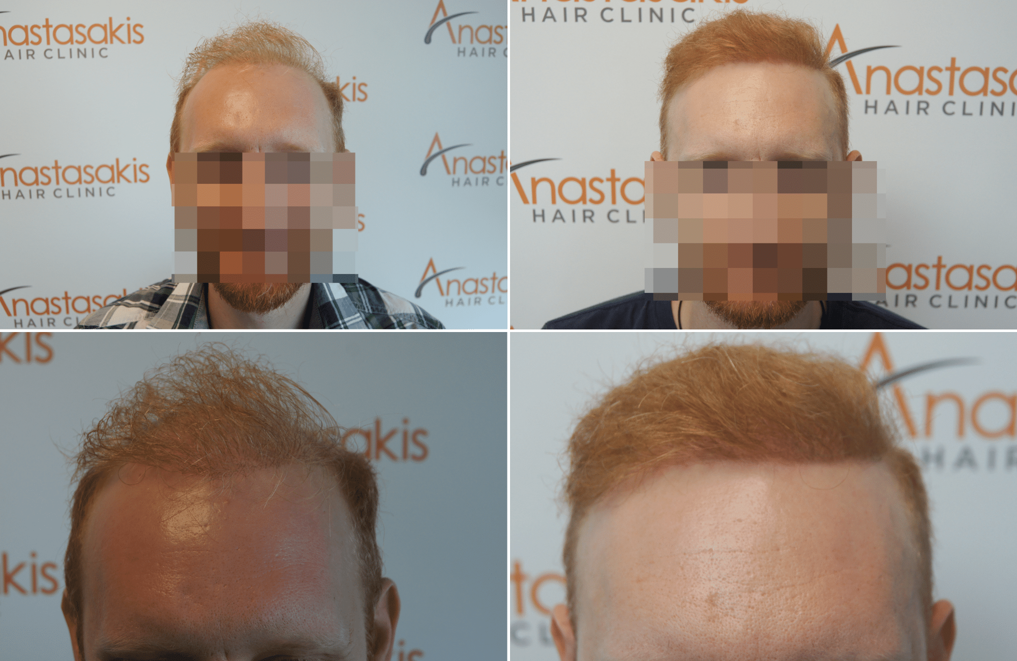 https://www.anastasakishairclinic.gr/portfolio/apotelesma-metamosxefsis-mallion-anastasakis-hair-clinic-392/