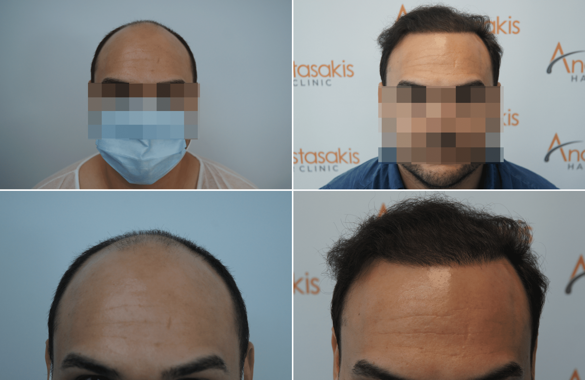 https://www.anastasakishairclinic.gr/portfolio/apotelesma-metamosxefsis-mallion-anastasakis-hair-clinic-393/