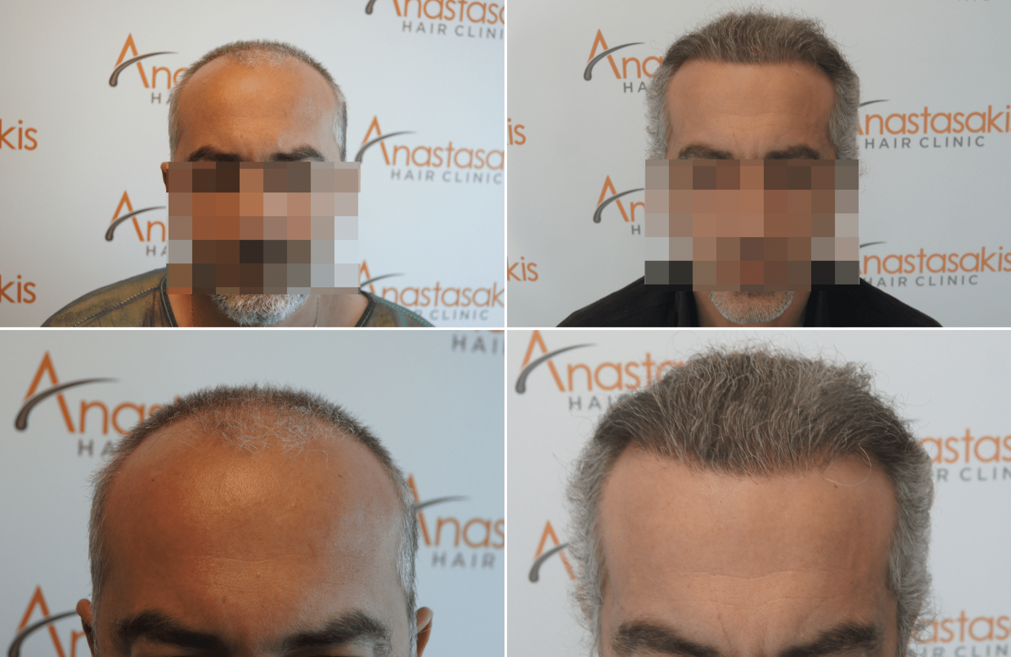 https://www.anastasakishairclinic.gr/portfolio/apotelesma-metamosxefsis-mallion-anastasakis-hair-clinic-394/