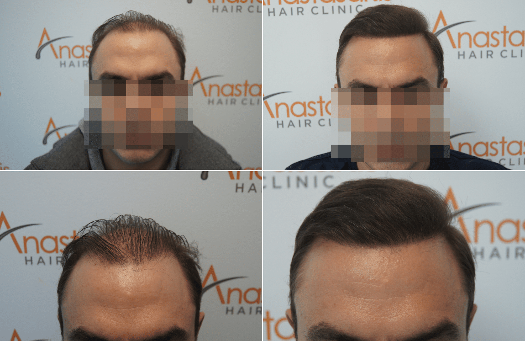 https://www.anastasakishairclinic.gr/portfolio/apotelesma-metamosxefsis-mallion-anastasakis-hair-clinic-395/