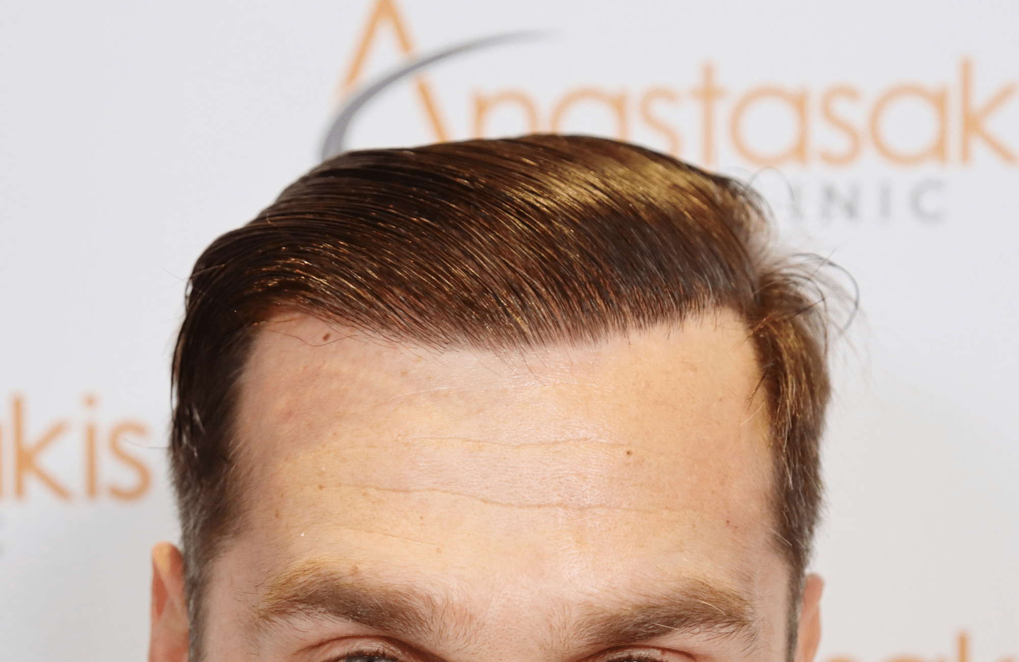 hair transplant result