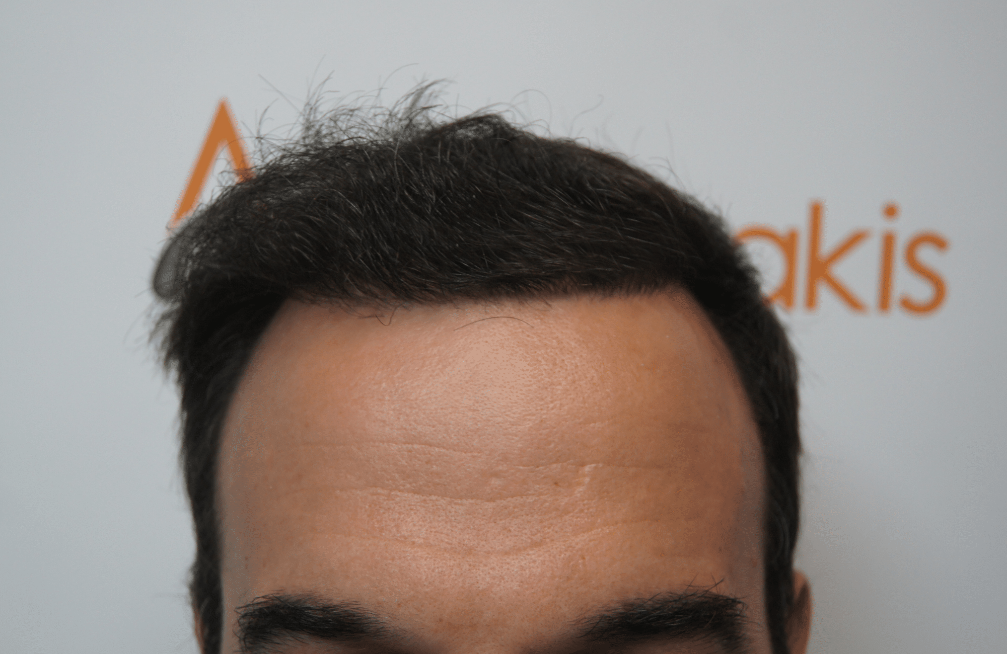 hair transplant patient result with 2500 fus after - hairline