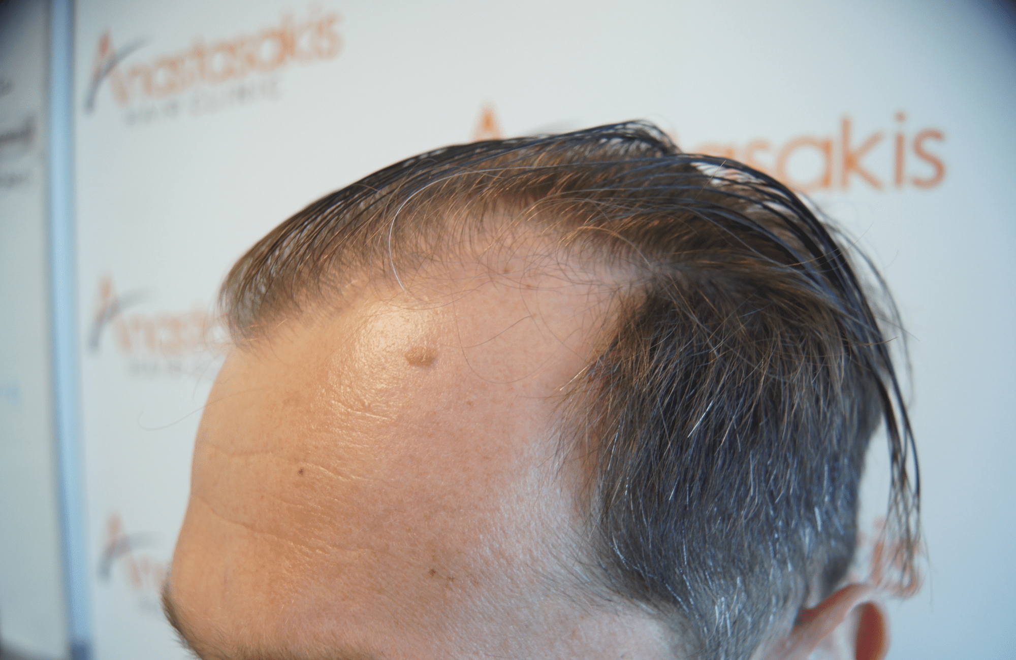 hair transplant result
