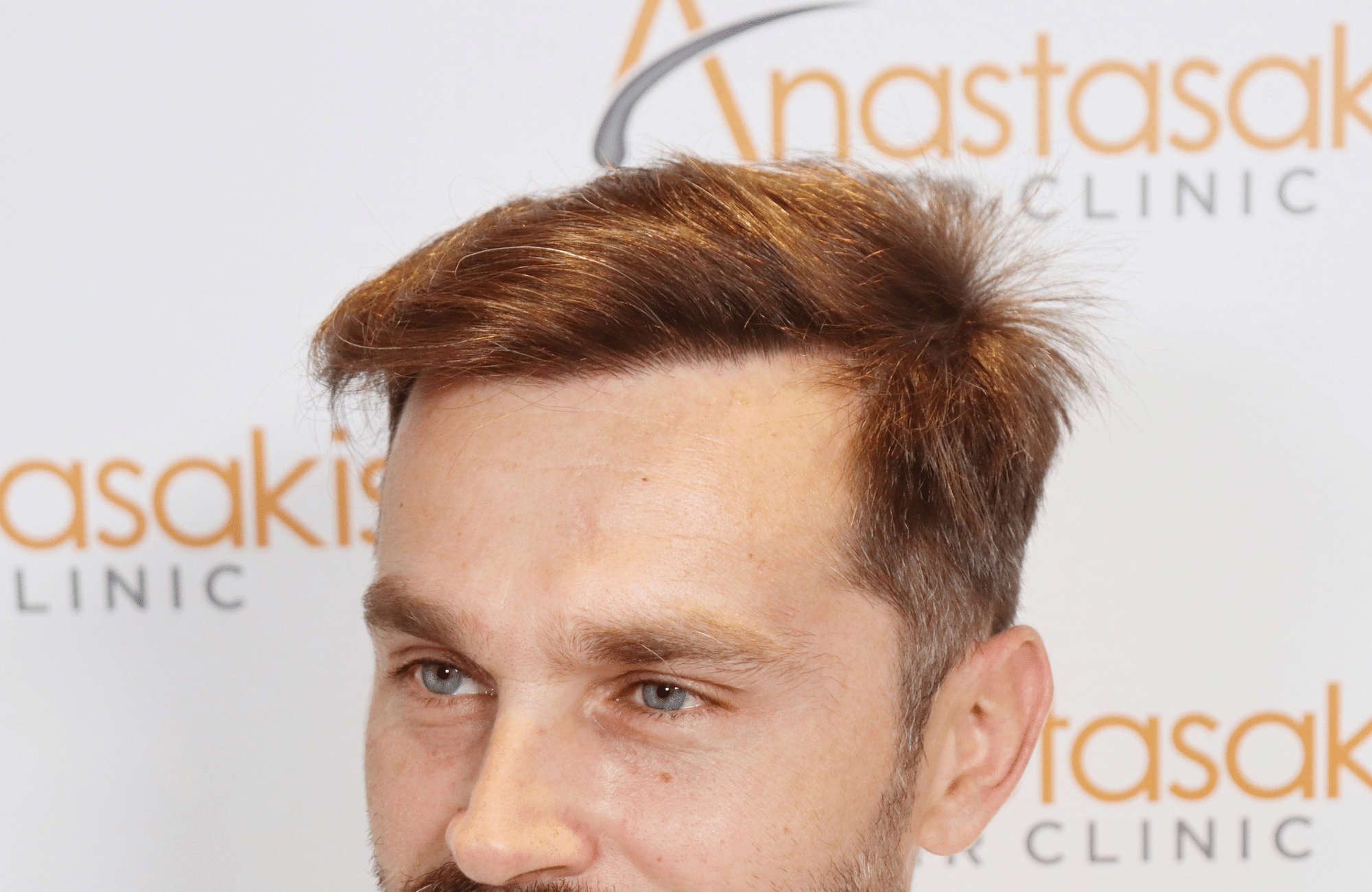 hair transplant result