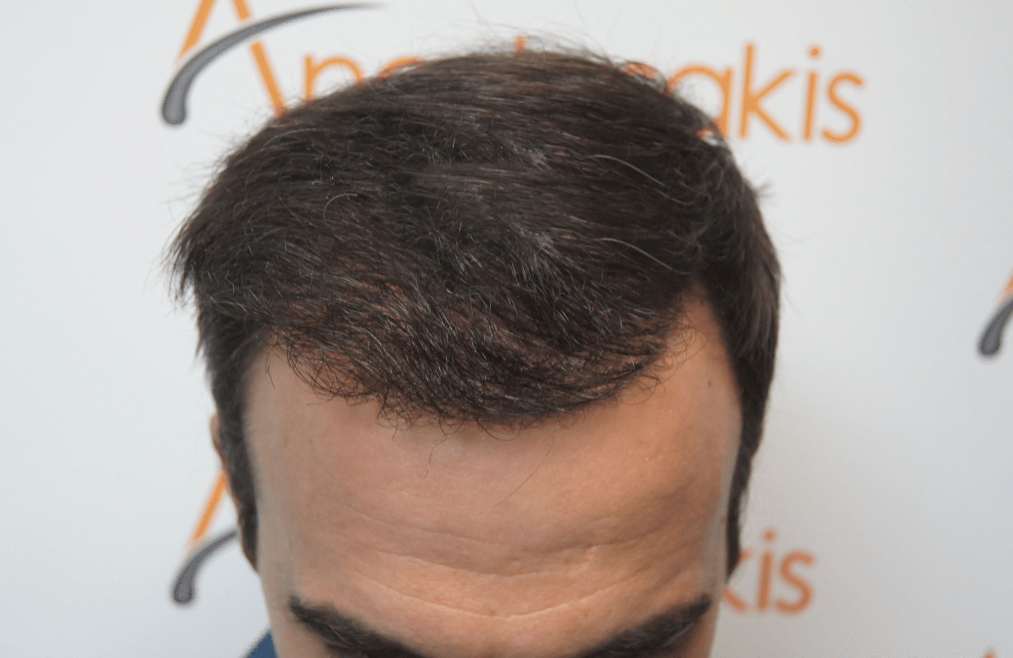 hair transplant patient result with 2500 fus after - frontal