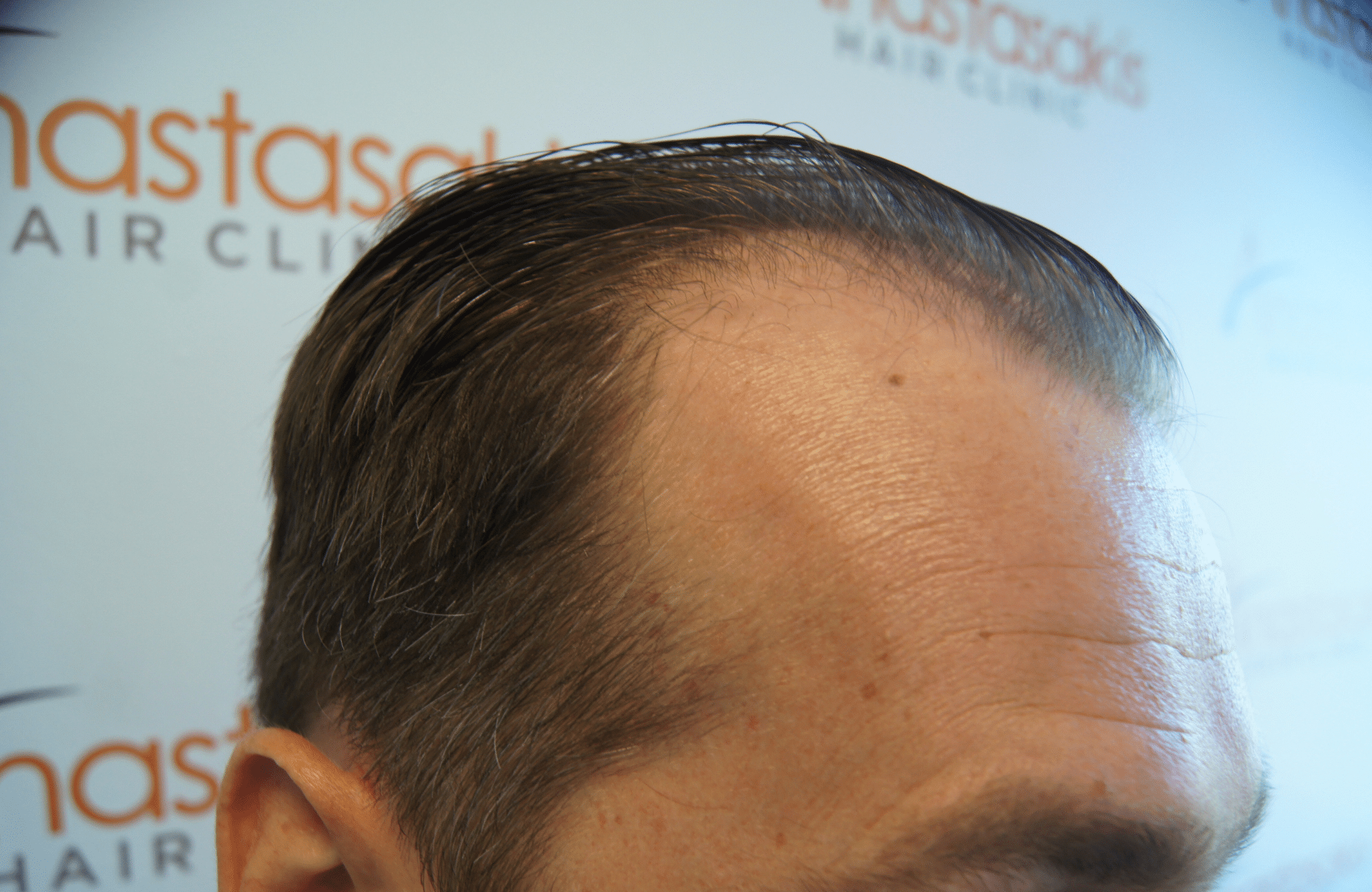 hair transplant result