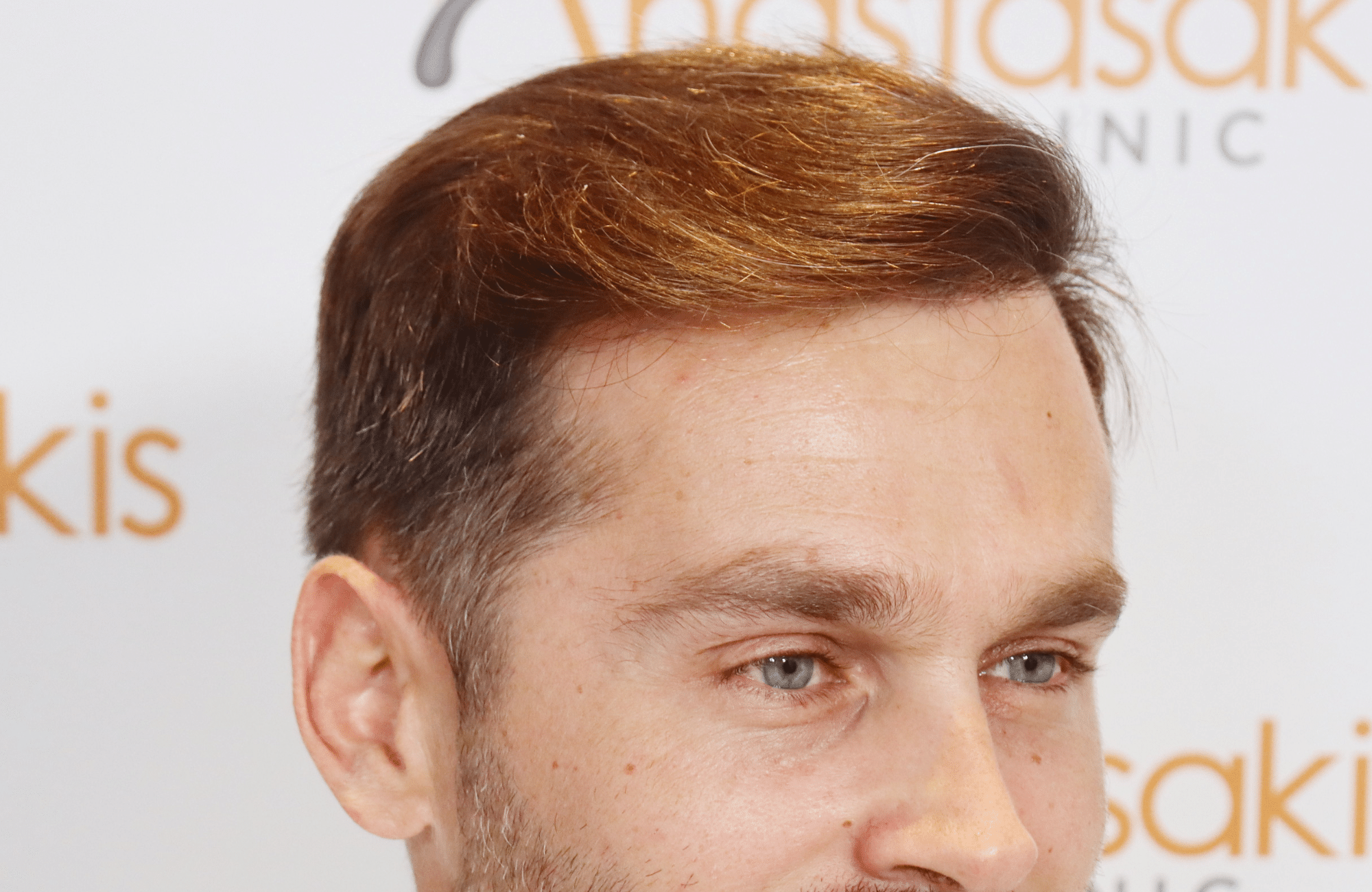 hair transplant result