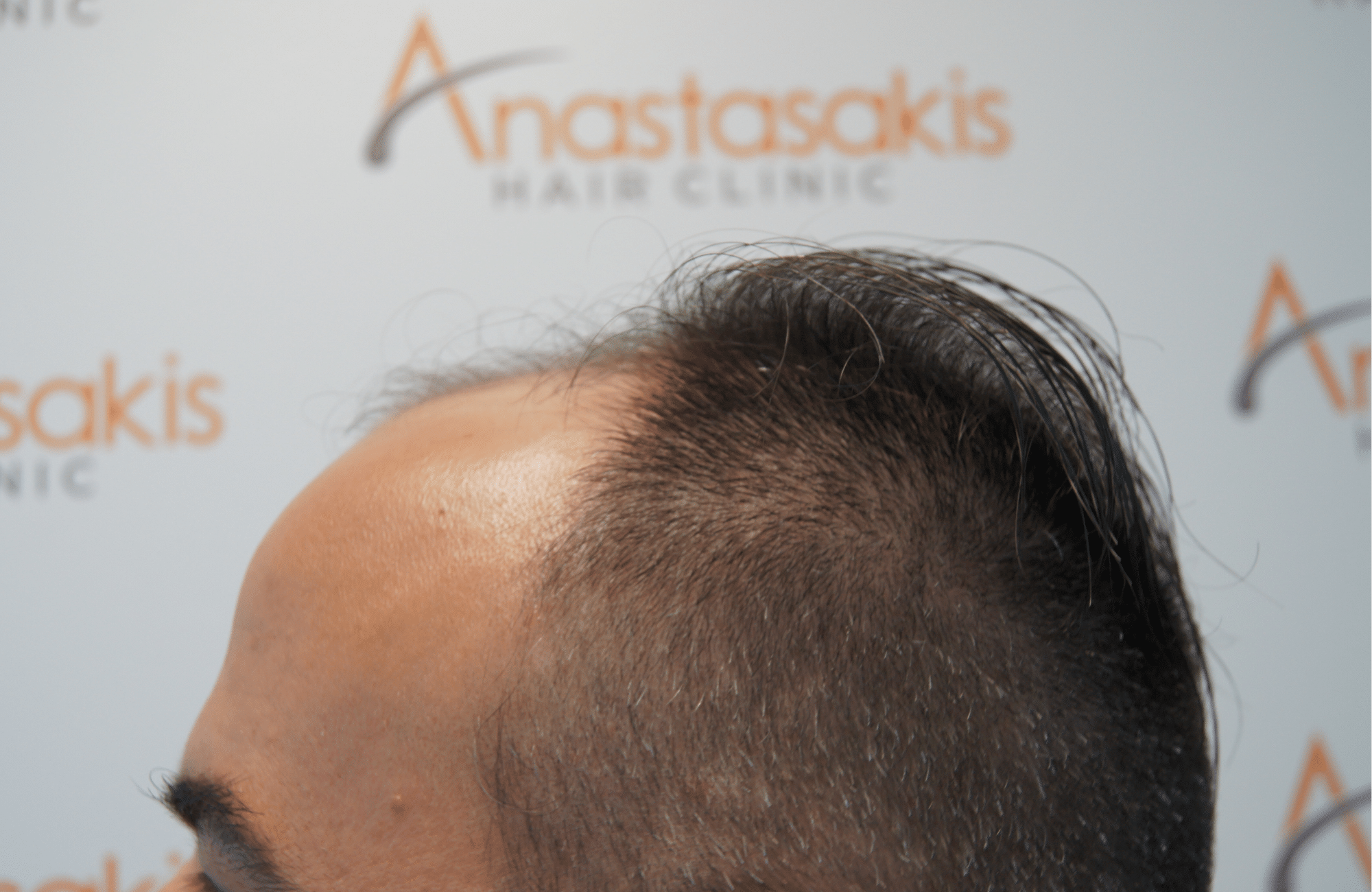 hair transplant patient result with 2500 fus before - side2