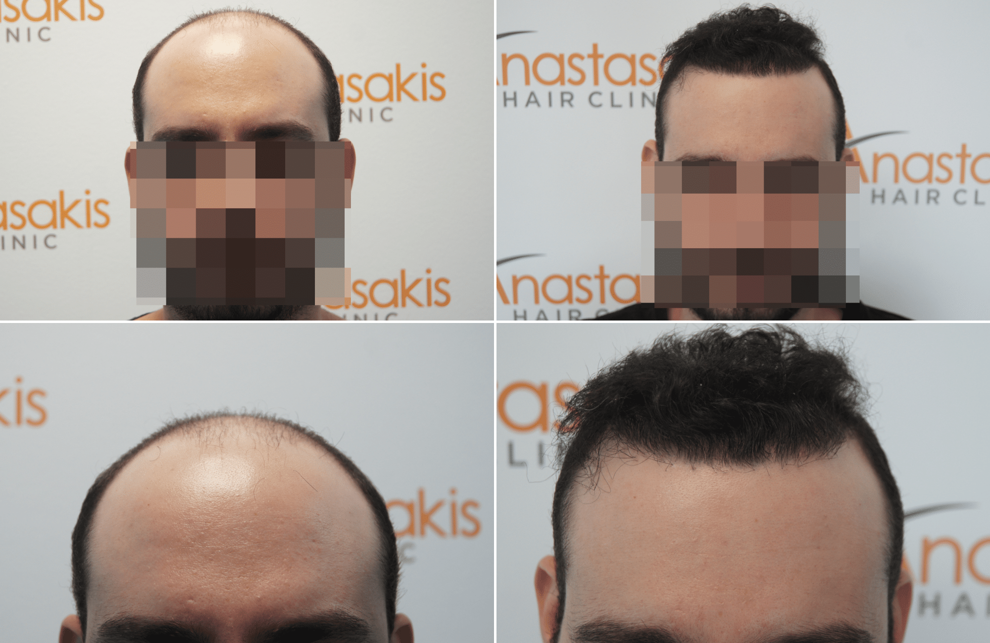 https://www.anastasakishairclinic.gr/portfolio/apotelesma-metamosxefsis-mallion-anastasakis-hair-clinic-406/