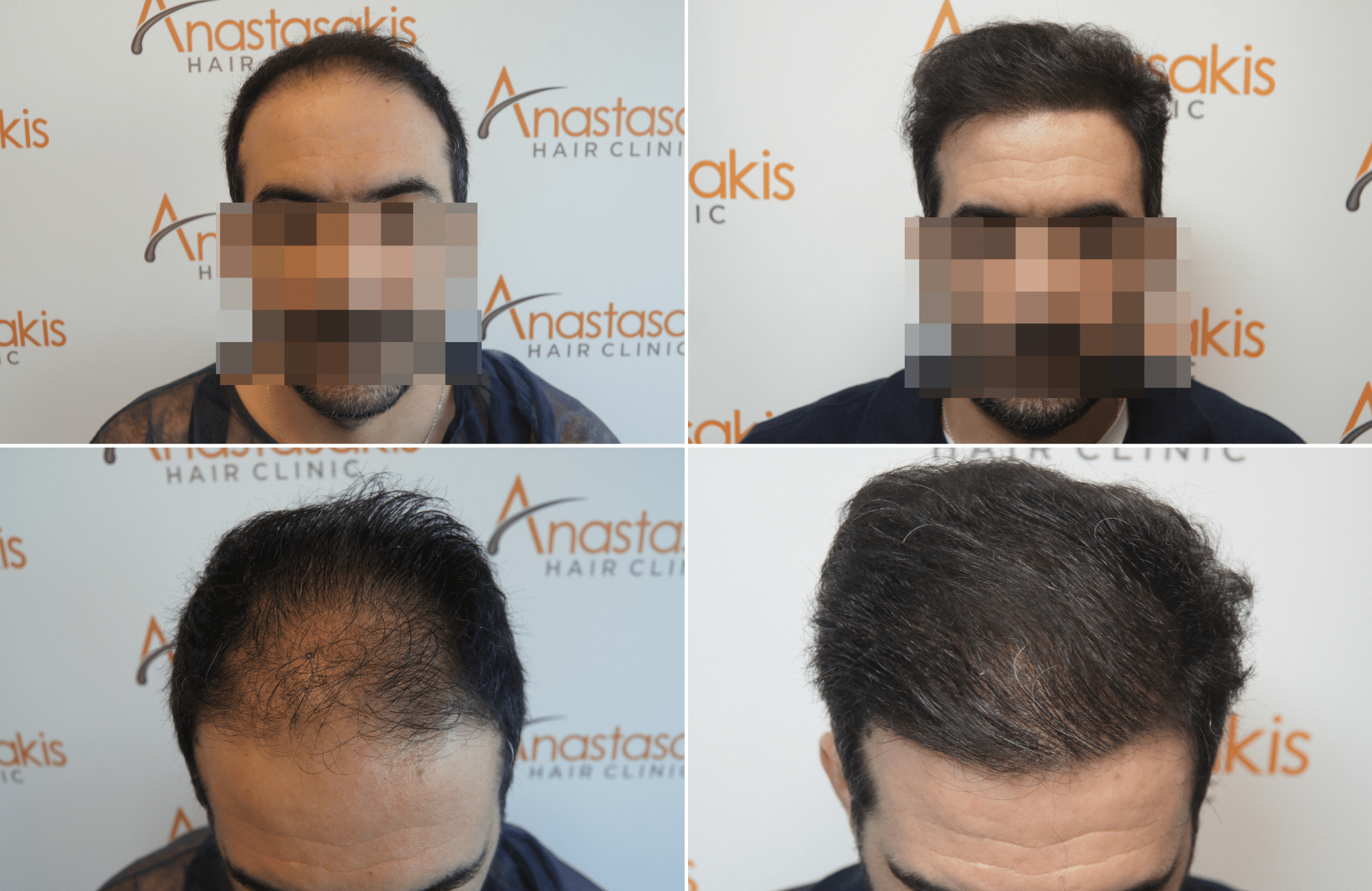 https://www.anastasakishairclinic.gr/portfolio/apotelesma-metamosxefsis-mallion-anastasakis-hair-clinic-396/