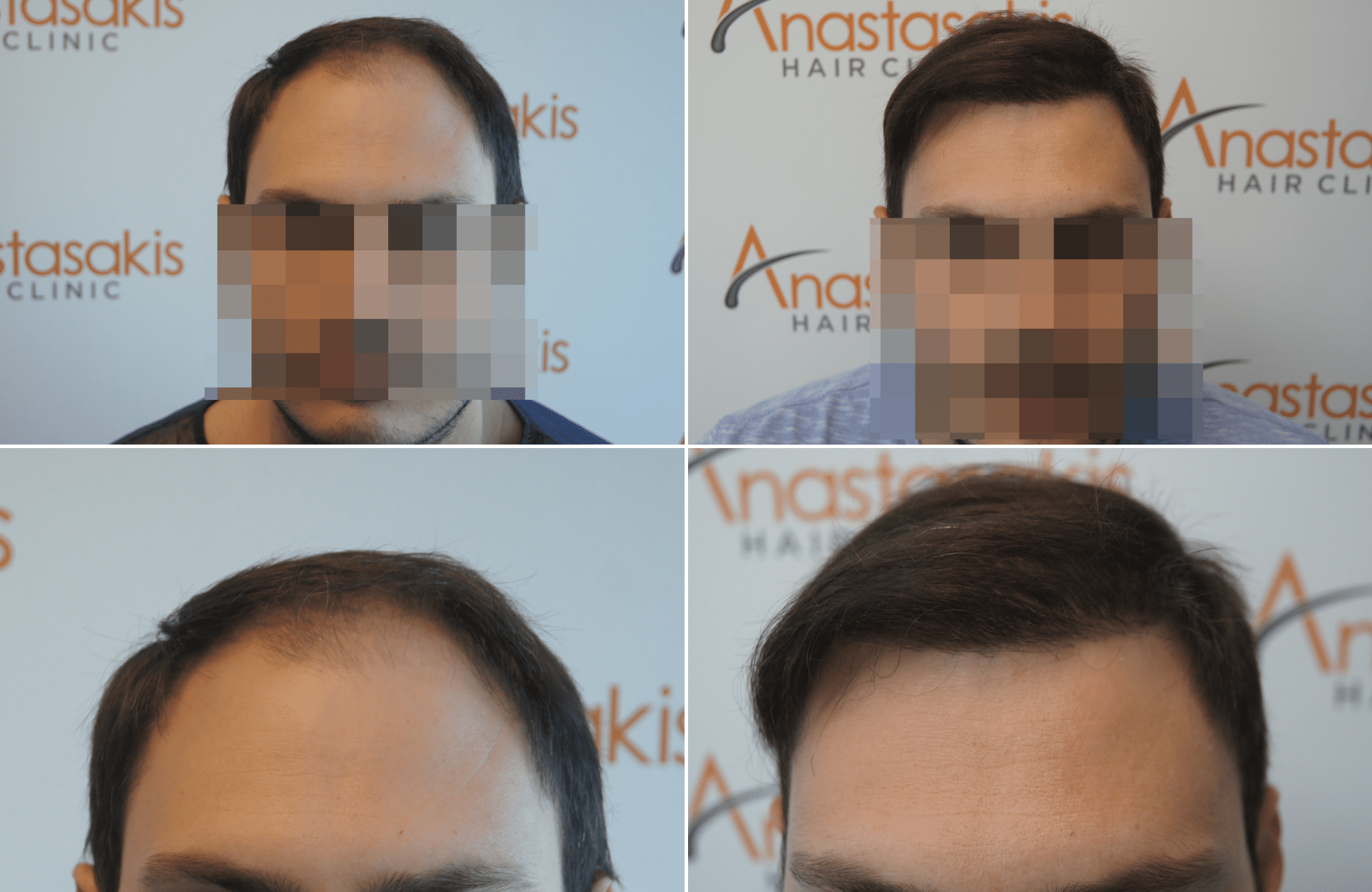 https://www.anastasakishairclinic.gr/portfolio/apotelesma-metamosxefsis-mallion-anastasakis-hair-clinic-399/