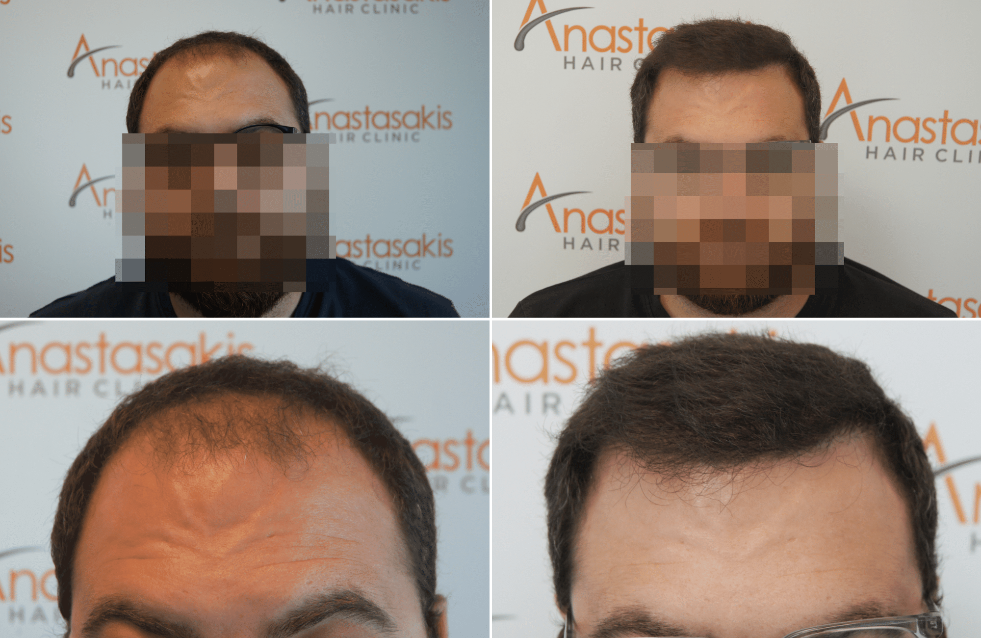 https://www.anastasakishairclinic.gr/portfolio/apotelesma-metamosxefsis-mallion-anastasakis-hair-clinic-400/