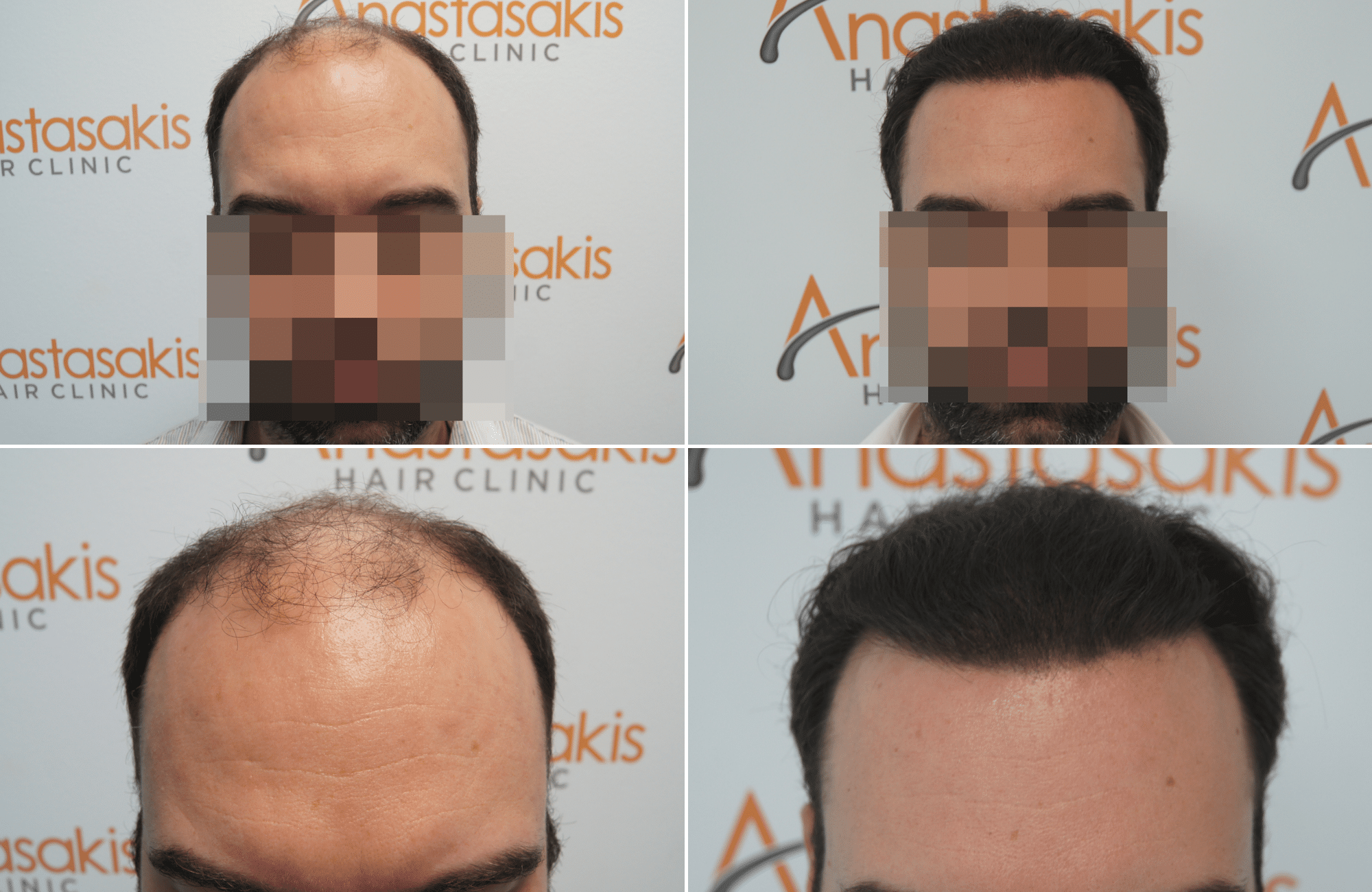 https://www.anastasakishairclinic.gr/portfolio/apotelesma-metamosxefsis-mallion-anastasakis-hair-clinic-404/