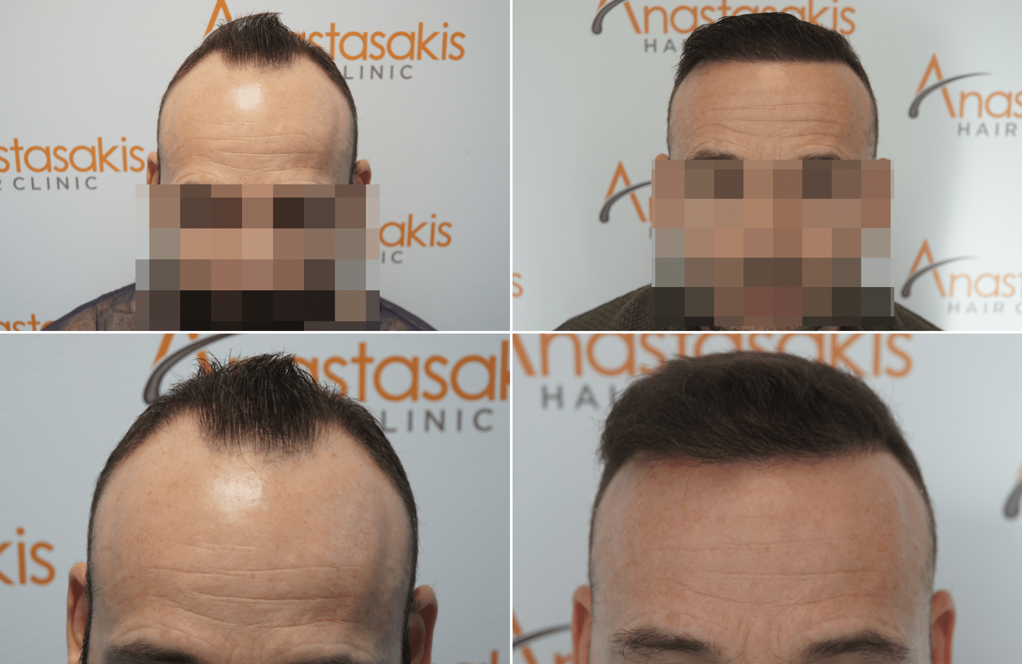 https://www.anastasakishairclinic.gr/portfolio/apotelesma-metamosxefsis-mallion-anastasakis-hair-clinic-405/