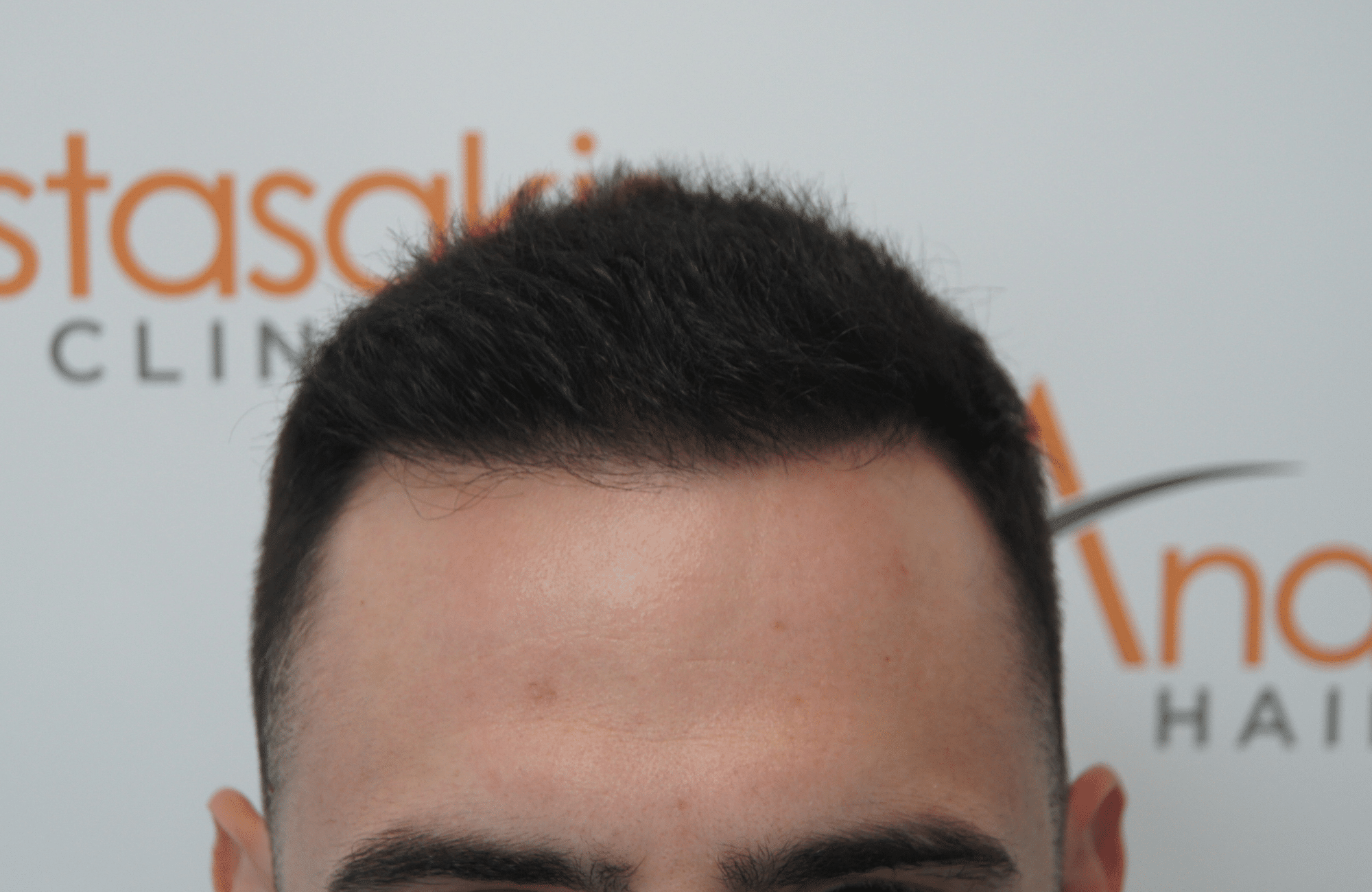 hair transplant patient result with 2100 fus after - hairline