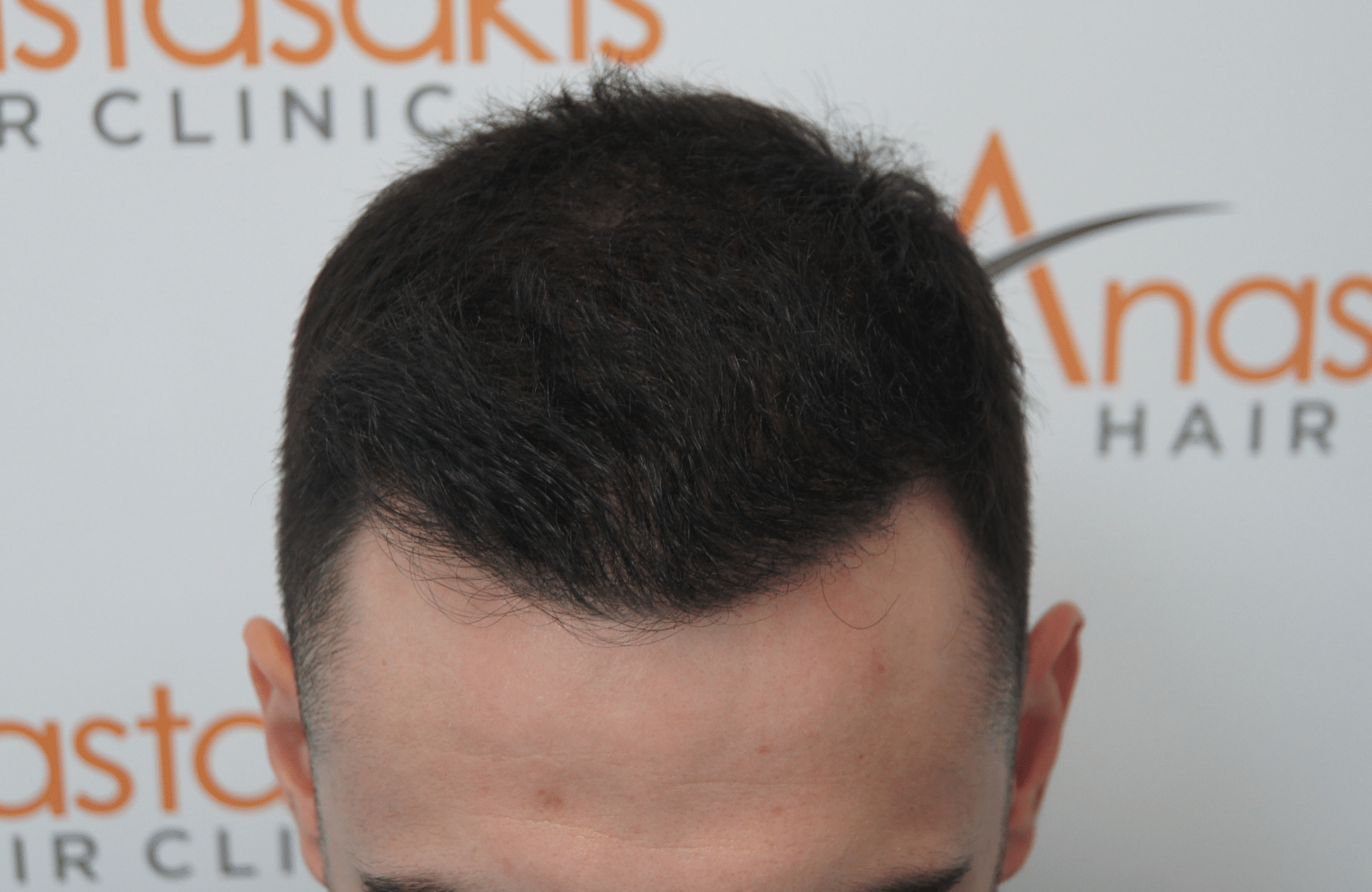 hair transplant patient result with 2100 fus after - frontal
