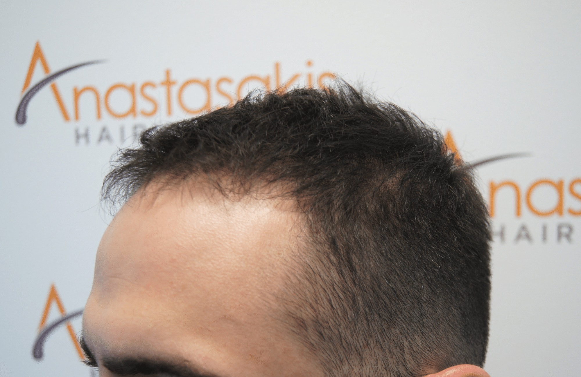 hair transplant patient result with 2100 fus before - side4
