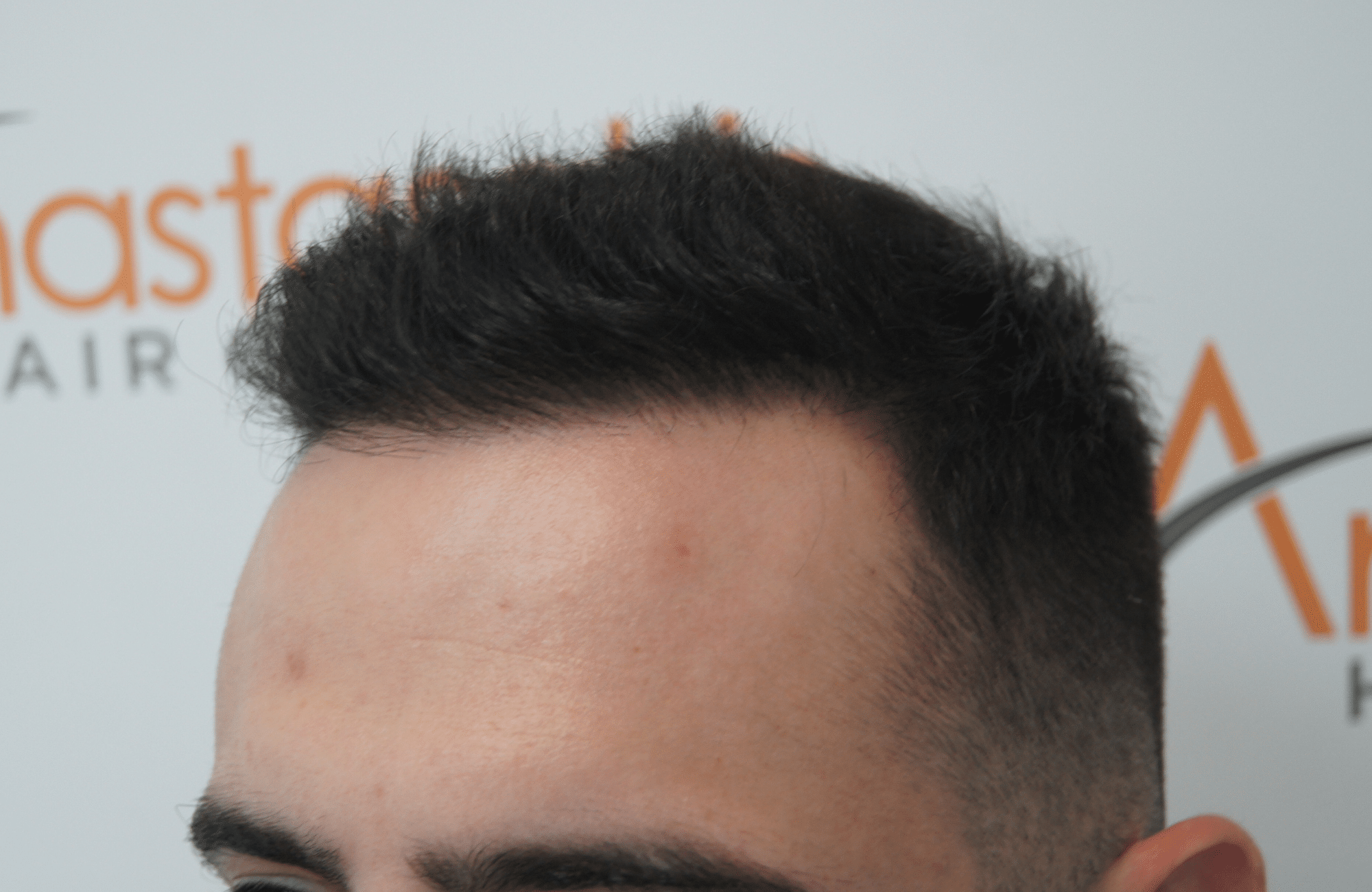 hair transplant patient result with 2100 fus after - side4