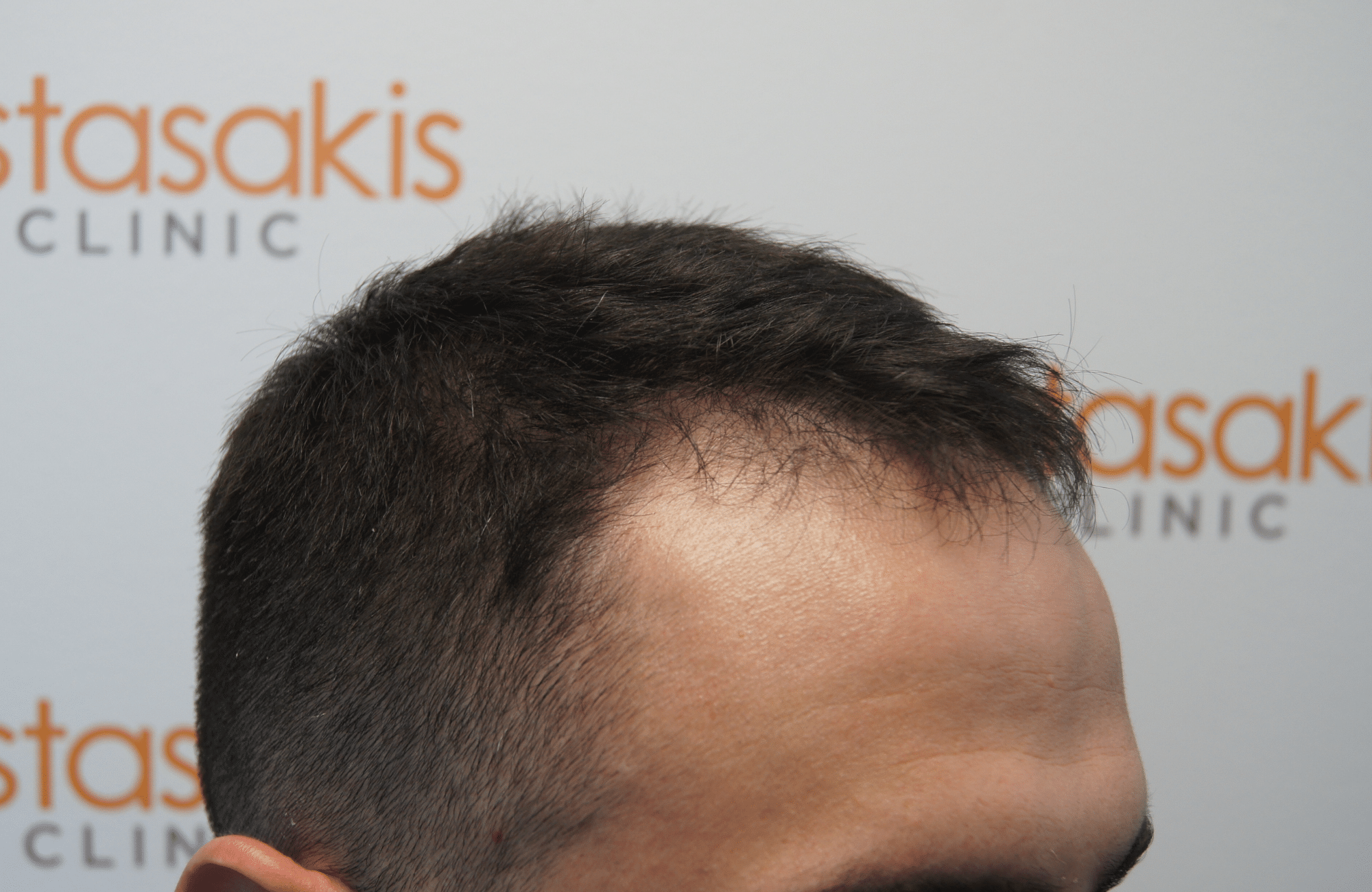 hair transplant patient result with 2100 fus before - side1