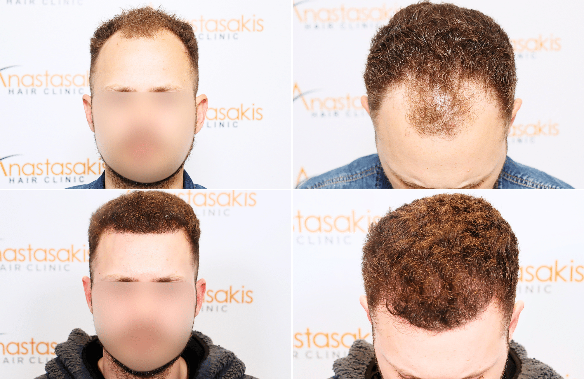 https://www.anastasakishairclinic.gr/portfolio/apotelesma-metamosxefsis-mallion-anastasakis-hair-clinic-387/