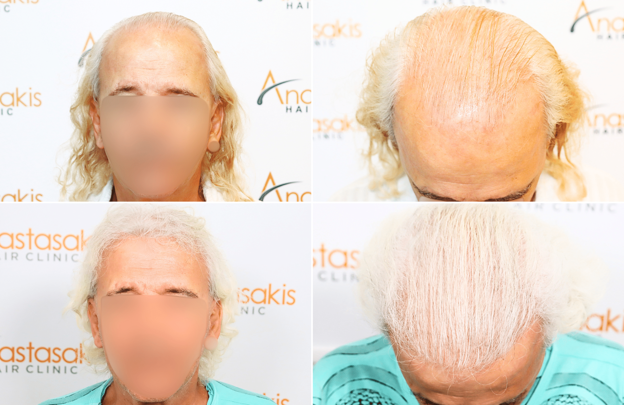 https://www.anastasakishairclinic.gr/portfolio/apotelesma-metamosxefsis-mallion-anastasakis-hair-clinic-407/