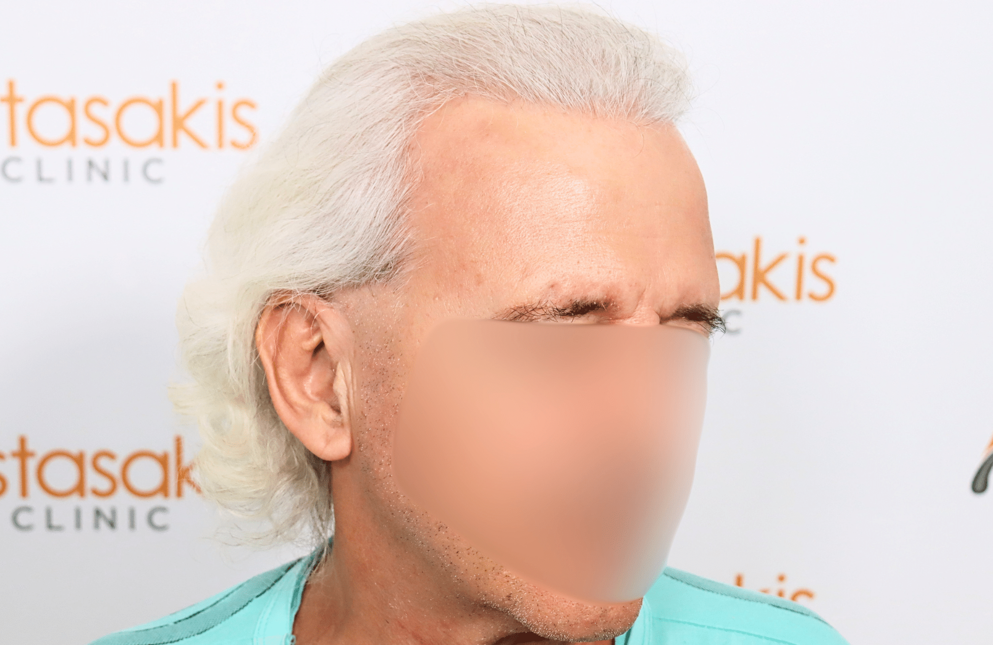 hair transplant result 2500 fus 6yo grey thin